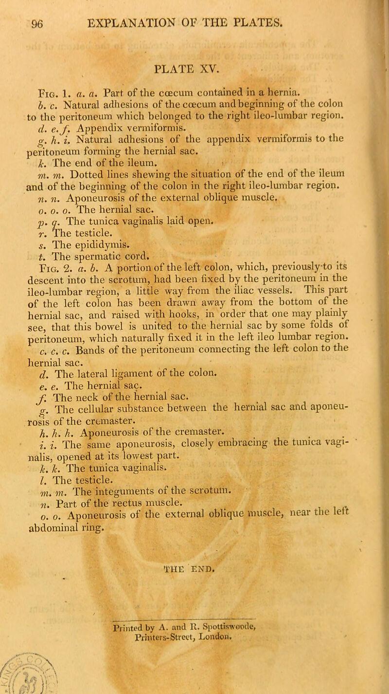 PLATE XV. Fig. 1. a. a. Part of the ccecum contained in a hernia. b. c. Natural adhesions of the ccecum and beginning of the colon to the peritoneum which belonged to the right ileo-lumbar region. d. e.J. Appendix vermiformis. <r. h. i. Natural adhesions of the appendix vermiformis to the peritoneum forming the hernial sac. k. The end of the ileum. m. m. Dotted lines shewing the situation of the end of the ileum and of the beginning of the colon in the right ileo-lumbar region. 7i. 7i. Aponeurosis of the external oblique muscle. 0. o. o. The hernial sac. j). q. The tunica vaginalis laid open. r. The testicle. s. The epididymis. t. The spermatic cord. Fig. 2. a. b. A portion of the left colon, which, previouslyto its descent into the scrotum, had been fixed by the peritoneum in the ileo-lumbar region, a little way from the iliac vessels. This part of the left colon has been drawn away from the bottom of the hernial sac, and raised with hooks, in order that one may plainly see, that this bowel is united to the hernial sac by some folds of peritoneum, which naturally fixed it in the left ileo lumbar region. c. c. c. Bands of the peritoneum connecting the left colon to the hernial sac. d. The lateral ligament of the colon. e. e. The hernial sac. f. The neck of the hernial sac. o-. The cellular substance between the hernial sac and aponeu- rosis of the cremaster. h. h. h. Aponeurosis of the cremaster. 1. i. The same aponeurosis, closely embracing the tunica vagi- nalis, opened at its lowest part. k. I-. The tunica vaginalis. l. The testicle. in. m. The integuments of the scrotum. 7i. Part of the rectus muscle. o. o. Aponeurosis of the external oblique muscle, near the left abdominal ring. THE END. Printed by A. and It. Spoltiswoxule, Printers-Strect, London.