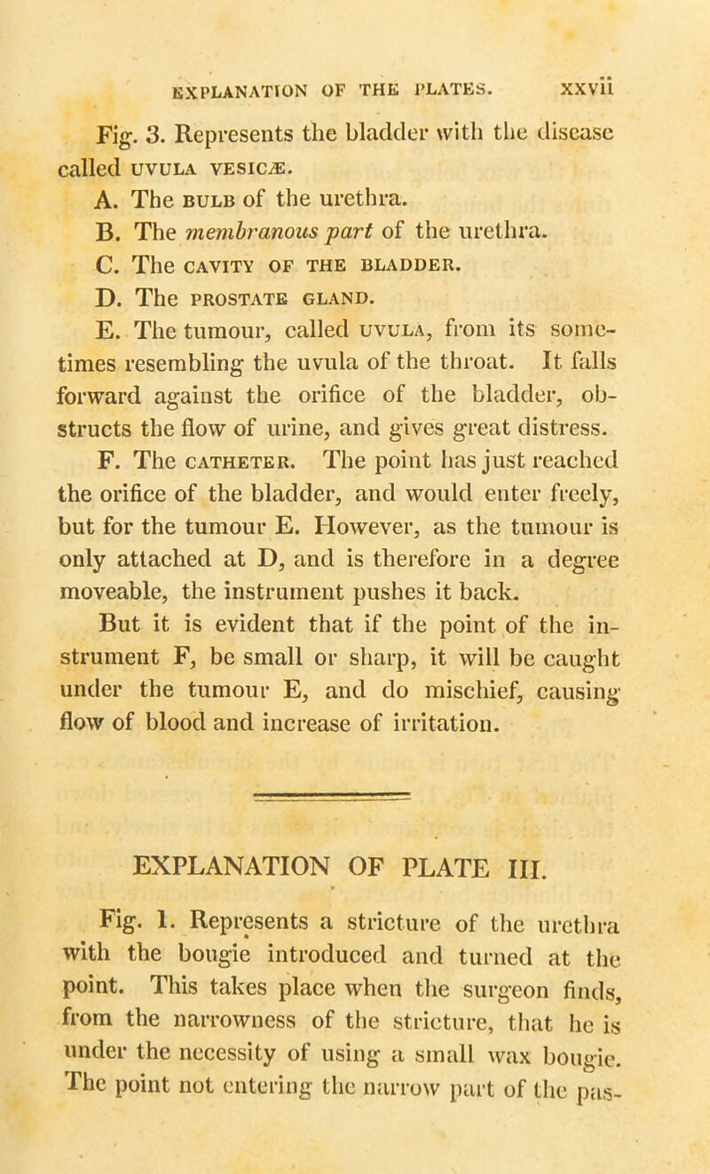 Fig. 3. Represents the bladder with the disease called uvula vesicle. A. The bulb of the urethra. B. The membranous part of the urethra. C. The CAVITY OF THE BLADDER. D. The PROSTATE GLAND. E. The tumour, called uvula, from its some- times resembling the uvula of the throat. It falls forward against the orifice of the bladder, ob- structs the flow of urine, and gives great distress. F. The catheter. The point has just reached the orifice of the bladder, and would enter freely, but for the tumour E. However, as the tumour is only attached at D, and is therefore in a degree moveable, the instrument pushes it back. But it is evident that if the point of the in- strument F, be small or sharp, it will be caught under the tumour E, and do mischief, causing flow of blood and increase of irritation. EXPLANATION OF PLATE III. Fig. 1. Represents a stricture of the urethra with the bougie introduced and turned at the point. This takes place when the surgeon finds, from the narrowness of the stricture, that he is under the necessity of using a small wax bougie. The point not entering the narrow part of the pas-