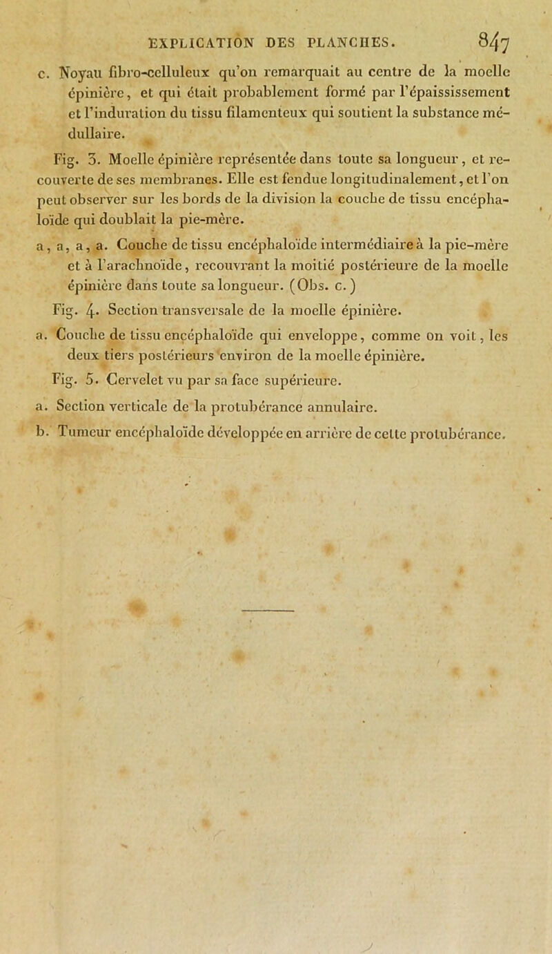 c. Noyau fibro-cclluleux qu’on remarquait au centre de la moelle épinière, et qui était probablement formé par l’épaississement et l’induration du tissu filamenteux qui soutient la substance mé- dullaire. Fig. 3. Moelle épinière représentée dans toute sa longueur , et re- couverte de ses membranes. Elle est fendue longitudinalement, et l’on peut observer sur les bords de la division la couche de tissu encépha- loïde qui doublait la pie-mère. a, a, a, a. Couche de tissu encéphaloïde intermédiaire à la pie-mère et à l’arachnoïde, recouvrant la moitié postérieure de la moelle épinière dans toute sa longueur. (Obs. c.) Fig. 4- Section transversale de la moelle épinière. a. Couche de tissu encéphaloïde qui enveloppe, comme on voit, les deux tiers postérieurs environ de la moelle épinière. Fig. 5. Cei’velet vu par sa face supérieure. a. Section verticale de la protubérance annulaire. b. Tumeur encéphaloïde développée en arrière de celle protubérance. y