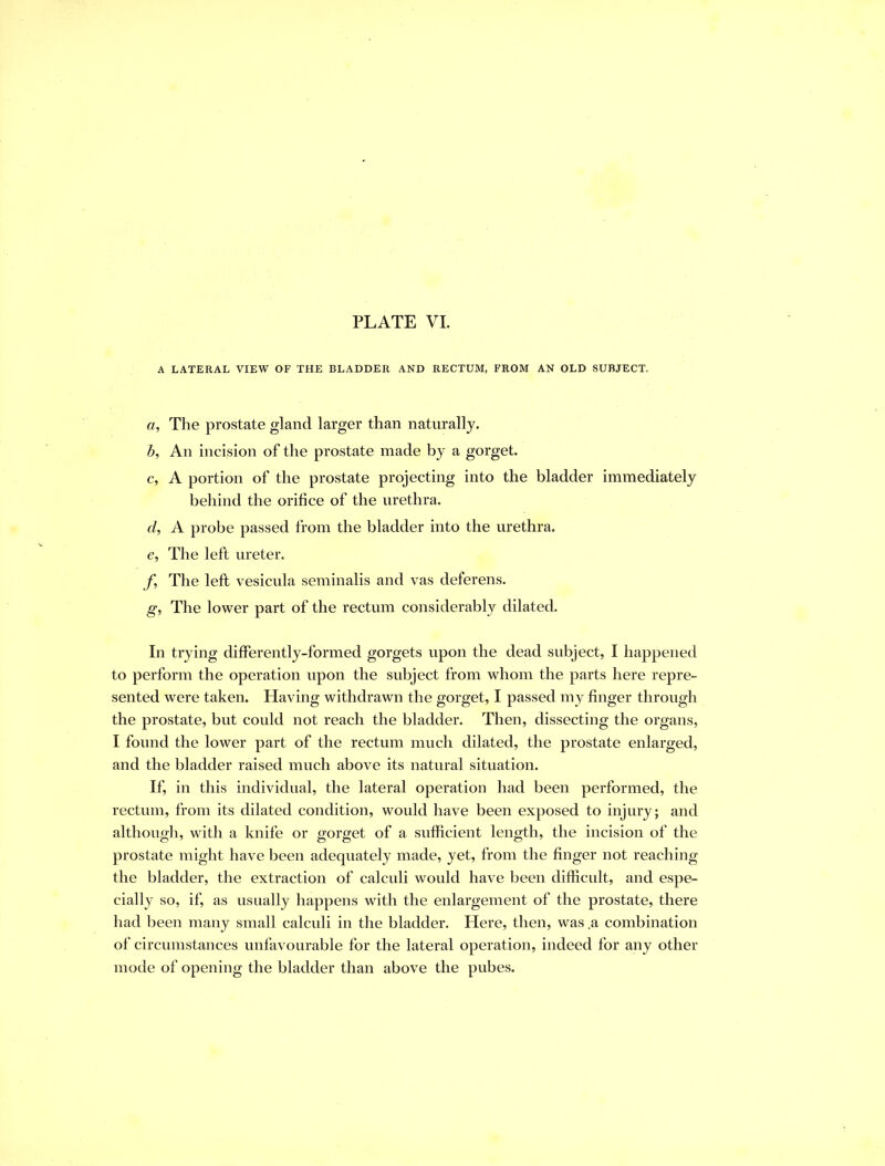 A LATERAL VIEW OF THE BLADDER AND RECTUM, FROM AN OLD SUBJECT. «, The prostate gland larger than naturally. h. An incision of the prostate made by a gorget. c, A portion of the prostate projecting into the bladder immediately behind the orifice of the urethra. d, A probe passed from the bladder into the urethra. e, The left ureter. /, The left vesicula seminalis and vas deferens. g, The lower part of the rectum considerably dilated. In trying differently-formed gorgets upon the dead subject, I happened to perform the operation upon the subject from whom the parts here repre- sented were taken. Having withdrawn the gorget, I passed my finger through the prostate, but could not reach the bladder. Then, dissecting the organs, I found the lower part of the rectum much dilated, the prostate enlarged, and the bladder raised much above its natural situation. If, in this individual, the lateral operation had been performed, the rectum, from its dilated condition, would have been exposed to injury; and although, with a knife or gorget of a sufficient length, the incision of the prostate might have been adequately made, yet, from the finger not reaching the bladder, the extraction of calculi would have been difficult, and espe- cially so, if, as usually happens with the enlargement of the prostate, there had been many small calculi in the bladder. Here, then, was .a combination of circumstances unfavourable for the lateral operation, indeed for any other mode of opening the bladder than above the pubes.