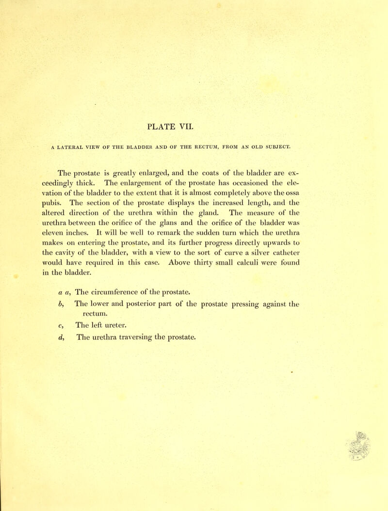 PLATE VII. A LATERAL VIEW OF THE BLADDER AND OF THE RECTUM, FROM AN OLD SUBJECT. The prostate is greatly enlarged, and the coats of the bladder are ex- ceedingly thick. The enlargement of the prostate has occasioned the ele- vation of the bladder to the extent that it is almost completely above the ossa pubis. The section of the prostate displays the increased length, and the altered direction of the urethra within the gland. The measure of the urethra between the orifice of the glans and the orifice of the bladder was eleven inches. It will be well to remark the sudden turn which the urethra makes on entering the prostate, and its further progress directly upwards to the cavity of the bladder, with a view to the sort of curve a silver catheter would have required in this case. Above thirty small calculi were found in the bladder. a «, The circumference of the prostate. b. The lower and posterior part of the prostate pressing against the rectum. c. The left ureter. d. The urethra traversing the prostate.