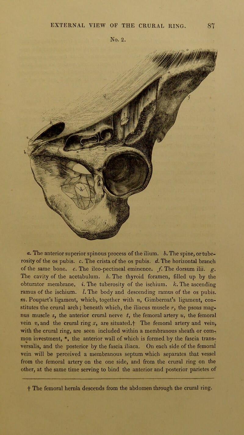 No. 2. a. The anterior superior spinous process of the ilium, b. The spine, or tube- rosity of the os pubis, c. The crista of the os pubis, d. The horizontal branch of the same bone. e. The ileo-pectineal eminence, f. The dorsum ilii. g. The cavity of the acetabulum, h. The thyroid foramen, filled up by the obturator membrane, i. The tuberosity of the ischium, k. The ascending ramus of the ischium. 1. The body and descending ramus of the os pubis. m. Poupart’s ligament, which, together with n, Gimbernat’s ligament, con- stitutes the crural arch; beneath which, the iliacus muscle r, the psoas mag- nus muscle s, the anterior crural nerve t, the femoral artery u, the femoral vein v, and the crural ring x, are situated.f The femoral artery and vein, with the crural ring, are seen included within a membranous sheath or com- mon investment, *, the anterior wall of which is formed by the fascia trans- versals, and the posterior by the fascia iliaca. On each side of the femoral vein will be perceived a membranous septum which separates that vessel from the femoral artery on the one side, and from the crural ring on the other, at the same time serving to bind the anterior and posterior parietes of f The femoral hernia descends from the abdomen through the crural ring.