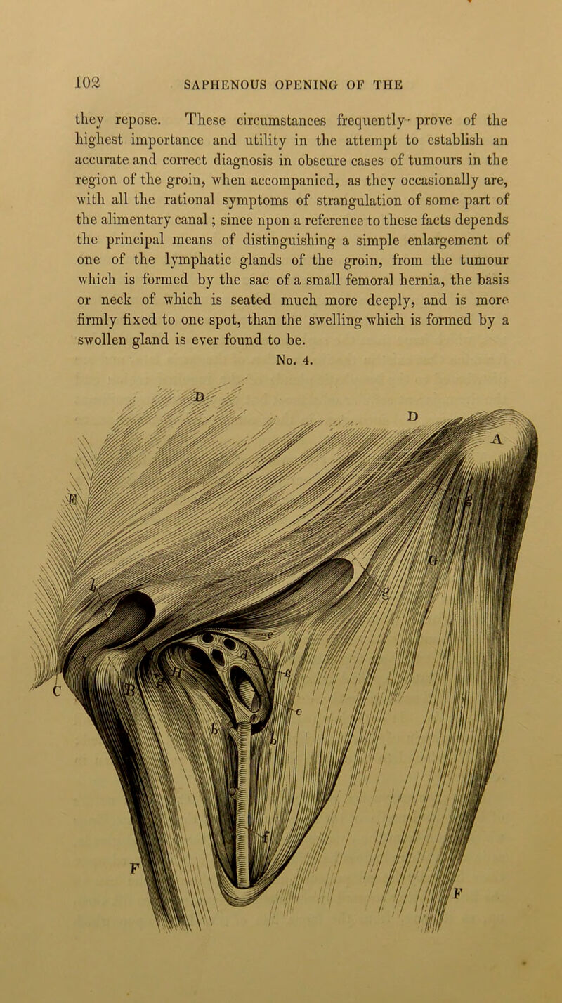 they repose. These circumstances frequently - prove of the highest importance and utility in the attempt to establish an accurate and correct diagnosis in obscure cases of tumours in the region of the groin, when accompanied, as they occasionally are, avith all the rational symptoms of strangulation of some part of the alimentary canal; since upon a reference to these facts depends the principal means of distinguishing a simple enlargement of one of the lymphatic glands of the groin, from the tumour which is formed by the sac of a small femoral hernia, the basis or neck of which is seated much more deeply, and is more firmly fixed to one spot, than the swelling which is formed by a swollen gland is ever found to be. No. 4.