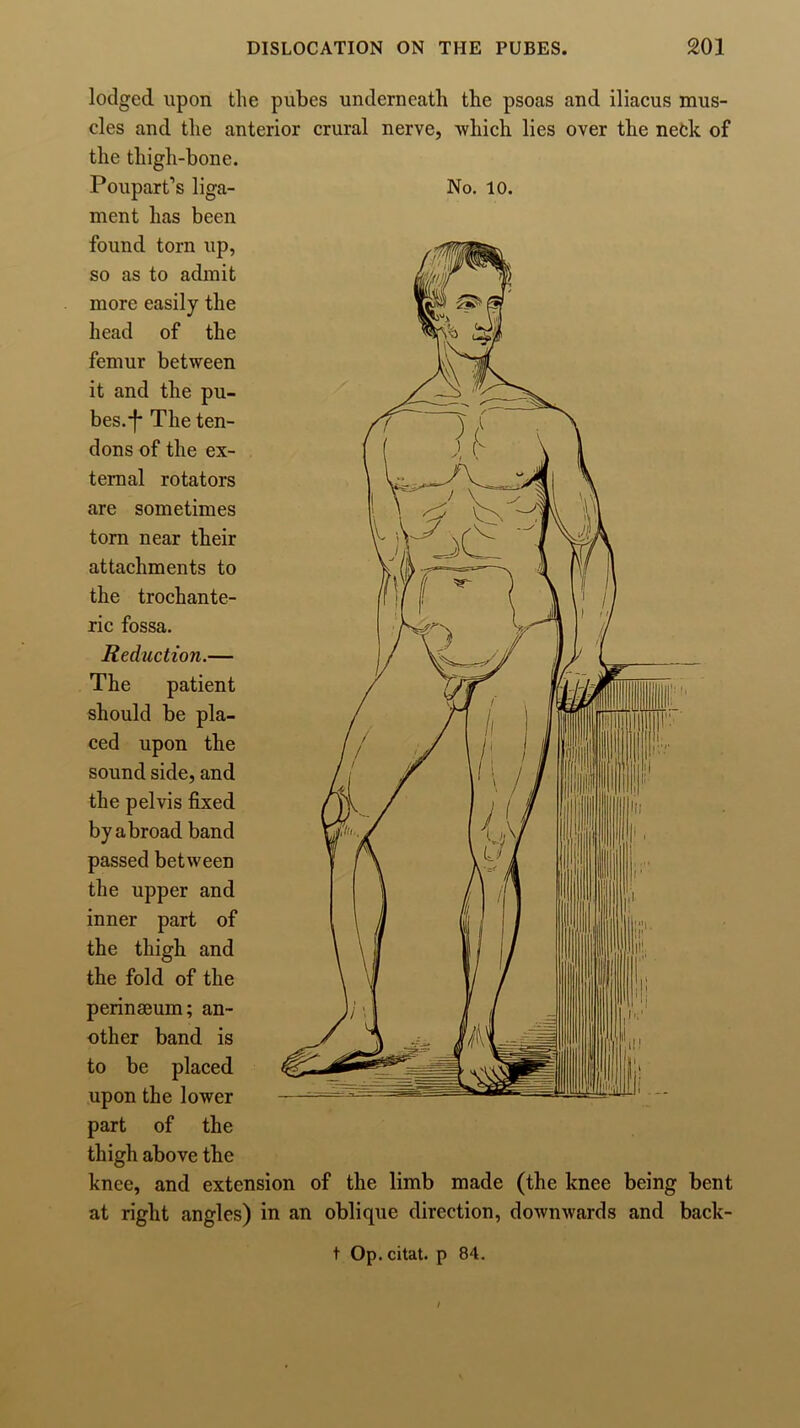 No. 10. lodged upon the pubes underneath the psoas and iliacus mus- cles and the anterior crural nerve, -which lies over the neck of the thigh-bone. Poupaxt’s liga- ment has been found torn up, so as to admit more easily the head of the femur between it and the pu- bes, f* The ten- dons of the ex- ternal rotators are sometimes torn near their attachments to the trochante- ric fossa. Reduction.— The patient should be pla- ced upon the sound side, and the pelvis fixed by abroad band passed between the upper and inner part of the thigh and the fold of the perinseum; an- other band is to be placed upon the lower part of the thigh above the knee, and extension of the limb made (the knee being bent at right angles) in an oblique direction, downwards and back- t Op. citat. p 84. I