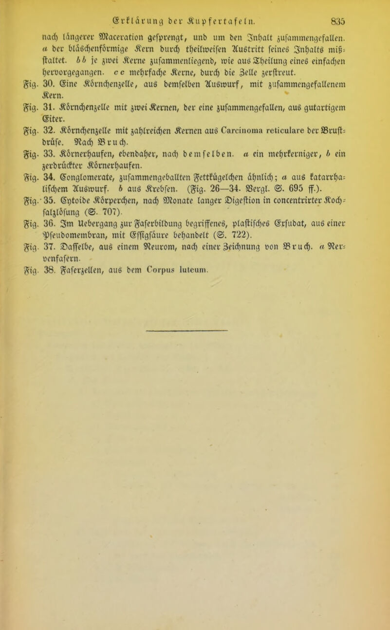 nad) längerer SOtaceration gefprengt, unb um ben 3nf)alt gufamtnengefallen. u bcu bläSdjenförmige &ern burdf) tfjeilmeifen TCuStritt feineg 3nl)alts mifb ftaltet. bb je groei Sinne gufammenliegenb, wie aus Sbeilung eines einfachen fyetoorgegangen. cc ntefjrfadje .Kerne, burd) bie Iklle gerflreut. Sig. 30. Sine Äbnu^enjeUe, aus bemfelben TfuSmurf, mit jufammengefallenem Äern. $ig. 31. Ä6rnd)enjelle mit jmei .Kernen, ber eine gufamtnengefallen, aus gutartigem Siter. gig. 32. .Korndjengetle mit galjlreidjen .Kernen aus Carcinoma reticulare ber SSrufb btüfe. 9tad) S3rud). gig. 33. .K&rnerf)aufen, ebenbafjet, nad) bemfelben. a ein mefjtferniger, b ein gerbrüefter .KörnerRaufen. ftig. 34. Songlomerate, gufammengeballten ^ttfügeldjen äfmlid); a aus fatarrf)a= lifd)em TtuSwurf. b aus .Krebfen. (gig. 26—34. fßergl. <5. 695 ff.). $ig.-35. Sptoibe .Körperchen, nad) Siflonate langer Sigeftion in concentrirter Äod)- falglöfung (@. 707). gig. 36. 3m Uebergang gur ^aferbilbung begriffenes, plaftifdjeS Srfubat, aus einer 'Pfeubomembran, mit Sfltgfäure beljanbelt (@. 722). gig. 37. ©affelbe, aus einem 9teurom, nad) einet 3eid)nung oon 93rud). a SRex- oenfafern. ?fig. 38. $afergellen, aus bem Corpus luteum.