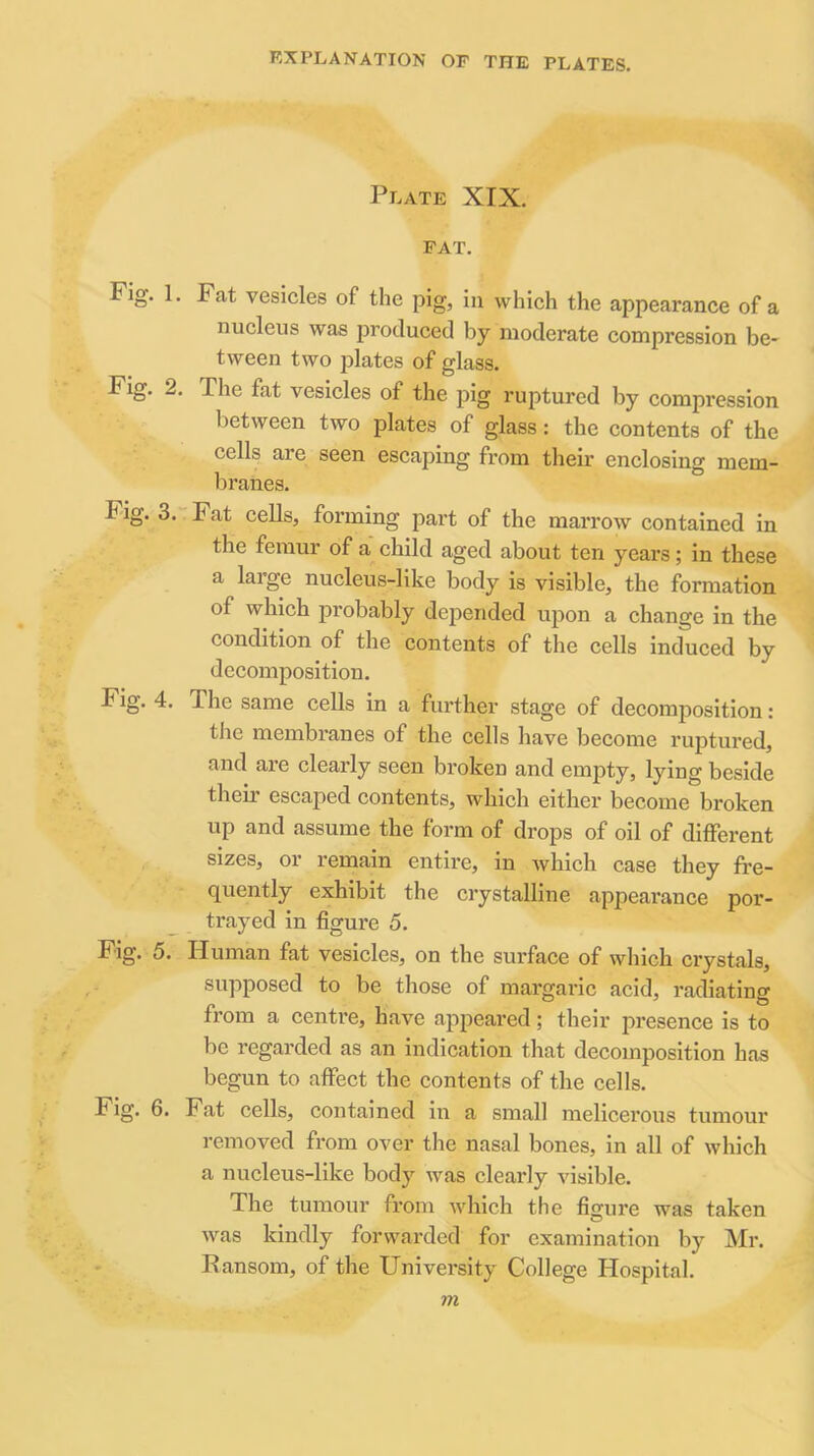 Plate XIX. FAT. Fig. 1. Fat vesicles of the pig, in which the appearance of a nucleus was produced by moderate compression be- tween two plates of glass. Fig. 2. The fat vesicles of the pig ruptured by compression between two plates of glass: the contents of the cells are seen escaping from then* enclosing mem- branes. Fig. 3. Fat cells, forming part of the marrow contained in the femur of a child aged about ten years; in these a large nucleus-like body is visible, the formation of which probably depended upon a change in the condition of the contents of tlie cells induced by decomposition. Fig. 4. The same cells in a further stage of decomposition: the membranes of the cells have become ruptured, and are clearly seen broken and empty, lying beside their escaped contents, which either become broken up and assume the form of drops of oil of different sizes, or remain entire, in which case they fre- quently exhibit the crystalline appearance por- trayed in figure 5. Fig. 5. Human fat vesicles, on the surface of which crystals, supposed to be those of margaric acid, radiating from a centre, have appeared; their presence is to be regarded as an indication that decomposition has begun to affect the contents of the cells. Fig. 6. Fat cells, contained in a small melicerous tumour removed from over the nasal bones, in all of which a nucleus-like body was clearly visible. The tumour from which the figure was taken Avas kindly forvs^arded for examination by Mr. • Ransom, of the University College Hospital. m