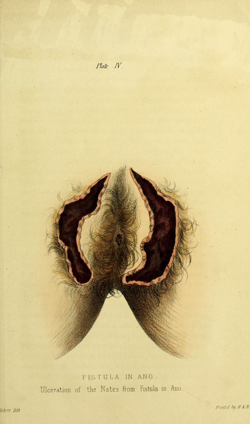 flak IV. Y [ S T U L A IN AN 0 . Ulceration of the Nates from fistula in Auo leben JM rnntal by. \f & N.