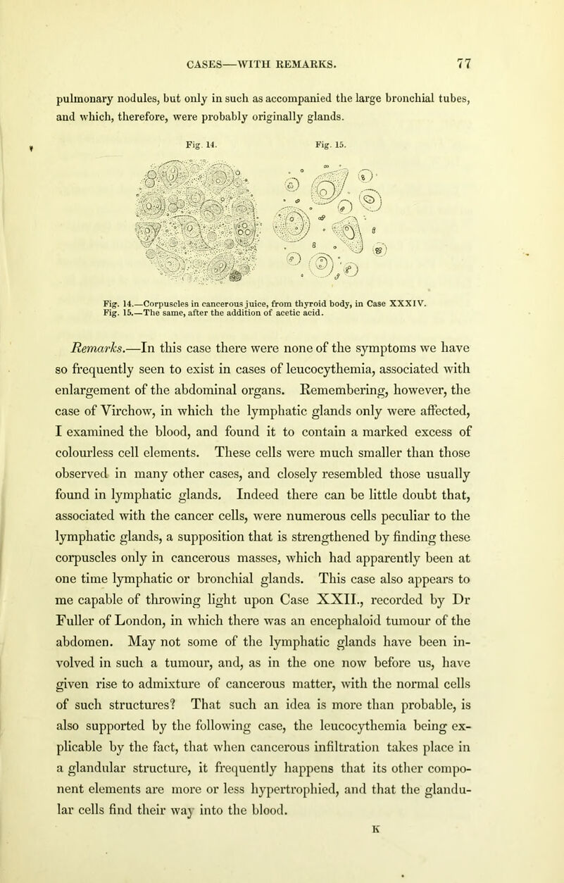 pulmonary nodules, but only in such as accompanied the large bronchial tubes, and which, therefore, were probably originally glands. Fig 14. Fig. 15. Fig. 14.—Corpuscles in cancerous juice, from thyroid body, in Case XXXIV. Fig. 15 The same, after the addition of acetic acid. Remarks.—In this case there were none of the symptoms we have so frequently seen to exist in cases of leucocythemia, associated with enlargement of the abdominal organs. Remembering, however, the case of Virchow, in which the lymphatic glands only were affected, I examined the blood, and found it to contain a marked excess of colourless cell elements. These cells were much smaller than those observed in many other cases, and closely resembled those usually found in lymphatic glands. Indeed there can be little doubt that, associated with the cancer cells, were numerous cells peculiar to the lymphatic glands, a supposition that is strengthened by finding these corpuscles only in cancerous masses, which had apparently been at one time lymphatic or bronchial glands. This case also appears to me capable of throwing light upon Case XXII., recorded by Dr Fuller of London, in which there was an encephaloid tumour of the abdomen. May not some of the lymphatic glands have been in- volved in such a tumour, and, as in the one now before us, have given rise to admixture of cancerous matter, with the normal cells of such structures? That such an idea is more than probable, is also supported by the following case, the leucocythemia being ex- plicable by the fact, that when cancerous infiltration takes place in a glandular structure, it frequently happens that its other compo- nent elements are more or less hypertrophied, and that the glandu- lar cells find their way into the blood. K