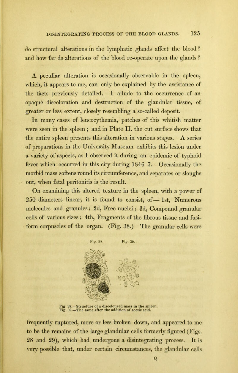 do structural alterations in the lymphatic glands affect the blood 1 and how far do alterations of the blood re-operate upon the glands f A peculiar alteration is occasionally observable in the spleen, which, it appears to me, can only be explained by the assistance of the facts previously detailed. I allude to the occurrence of an opaque discoloration and destruction of the glandular tissue, of greater or less extent, closely resembling a so-called deposit. In many cases of leucoeythemia, patches of this ivhitish matter were seen in the spleen ; and in Plate H. the cut surface shows that the entire spleen presents this alteration in various stages. A series of preparations in the University Museum exhibits this lesion under a variety of aspects, as I observed it during an epidemic of typhoid fever which occurred in this city during 1846-7. Occasionally the morbid mass softens round its circumference, and separates or sloughs out, when fatal peritonitis is the result. On examining this altered texture in the spleen, -with a power of 250 diameters linear, it is found to consist, of— 1st, Numerous molecules and granules; 2d, Free nuclei; 3d, Compound granular cells of various sizes ; 4th, Fragments of the fibrous tissue and fusi- form corpuscles of the organ. (Fig. 38.) The granular cells were Fig. 38. Fig 39.. Fig 38 Structure of a discoloured mass in the spleen. Fig. 39.—The same after the addition of acetic acid. frequently ruptured, more or less broken down, and appeared to me to be the remains of the large glandular cells formerly figured (Figs. 28 and 29), which had undergone a disintegrating process. It is very possible that, under certain circumstances, the glandular cells Q