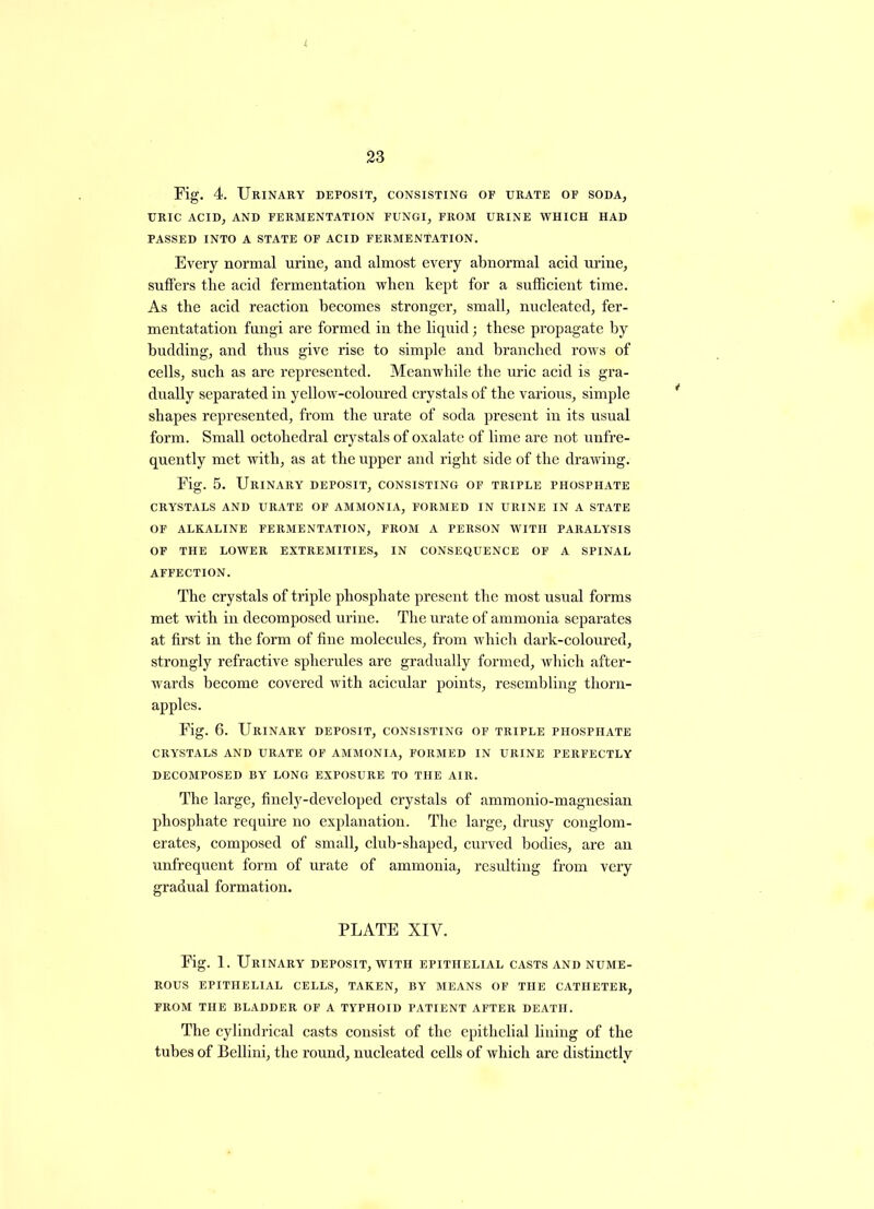 Fig. 4. Urinary deposit, consisting of urate of soda, URIC ACID, AND FERMENTATION FUNGI, FROM URINE WHICH HAD PASSED INTO A STATE OF ACID FERMENTATION. Every normal urine, and almost every abnormal acid urine, suffers the acid fermentation when kept for a sufficient time. As the acid reaction becomes stronger, small, nucleated, fer- mentatation fungi are formed in the liquid; these propagate by budding, and thus give rise to simple and branched rows of cells, such as are represented. Meanwhile the uric acid is gra- dually separated in yellow-coloured crystals of the various, simple shapes represented, from the urate of soda present in its usual form. Small octohedral crystals of oxalate of lime are not unfre- quently met with, as at the upper and right side of the drawing. Fig. 5. Urinary deposit, consisting of triple phosphate CRYSTALS AND URATE OF AMMONIA, FORMED IN URINE IN A STATE OF ALKALINE FERMENTATION, FROM A PERSON WITH PARALYSIS OF THE LOWER EXTREMITIES, IN CONSEQUENCE OF A SPINAL AFFECTION. The crystals of triple phosphate present the most usual forms met with in decomposed urine. The urate of ammonia separates at first in the form of fine molecules, from which dark-coloured, strongly refractive spherules are gradually formed, which after- wards become covered with acicular points, resembling thorn- apples. Fig. 6. Urinary deposit, consisting of triple phosphate CRYSTALS AND URATE OF AMMONIA, FORMED IN URINE PERFECTLY DECOMPOSED BY LONG EXPOSURE TO THE AIR. The large, finely-developed crystals of ammonio-magnesian phosphate require no explanation. The large, drusy conglom- erates, composed of small, club-shaped, curved bodies, are an unfrequent form of urate of ammonia, resulting from very gradual formation. PLATE XIY. Fig. 1. Urinary deposit, with epithelial casts and nume- rous EPITHELIAL CELLS, TAKEN, BY MEANS OF THE CATHETER, FROM THE BLADDER OF A TYPHOID PATIENT AFTER DEATH. The cylindrical casts consist of the epithelial fining of the tubes of Bellini, the round, nucleated cells of which are distinctly