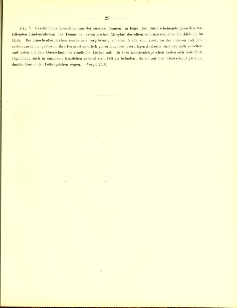 Fig. V. Geschliffenes Lamellchen aus der äusserst dünnen, in feine, fast durchscheinende Lamellen zer- fallenden Rindensubstanz des Femur bei excentrischer Atrophie desselben und massenhafter Fellbildung im Mark. Die Knochenkörperchen erscheinen vergrössert, an einer Stelle sind zwei, an der anderen drei der- selben zusammengeflossen, ihre Form ist rundlich geworden; ihre faserartigen Ausläufer sind ebenfalls erweitert und treten auf dem Querschnitt als rundliche Löcher auf. In zwei Knochenkörperchen finden sich viele Fett- kügelchen, auch in einzelnen Kanälchen scheint sich Fett in befinden, da sie auf dem Querschnitt ganz die dunkle Contur der Fettkügelchen zeigen. (Yergr. 240.)