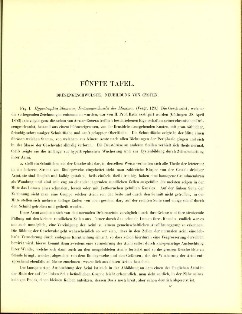 DRÜSENGESCHWÜLSTE, NEUBILDUNG VON CYSTEN. Fig. I. Hypertrophia Mammae, Drüsengeschwulst der Mamma. (Vergr. 120.) Die Geschwulst, welcher die vorliegenden Zeichnungen entnommen wurden, war von II. Prof. Baum exstirpirt worden (Göttingen 28. April 1853); sie zeigte ganz die schon von Astley Cooper trefflich beschriebenen Eigenschaften seiner chronischen Drü- sengeschwulst, bestand aus einem hühnereigrossen, von der Brustdrüse ausgehenden Knoten, mit grau-röthlicher, fleischig-schwammiger Schnittfläche und sanft gelappter Oberfläche. Die Schnittfläche zeigte in der Mitte einen fibrösen weichen Stamm, von welchem aus feinere Aeste nach allen Richtungen der Peripherie gingen und sich in der Masse der Geschwulst allmälig verloren. Die Brustdrüse an anderen Stellen verhielt sich theils normal, theils zeigte sie die Anfänge zur hypertrophischen Wucherung und zur Cystenbildung durch Zellenentartung ihrer Acini. a. stellt ein Schnittchen aus der Geschwulst dar, in derselben Weise verhielten sich alle Theile der letzteren; in ein lockeres Stroma von Bindegewebe eingebettet sieht man zahlreiche Körper von der Gestalt drüsiger Acini, sie sind länglich und kolhig gestaltet, theils einfach, theils trauhig, haben eine homogene Grundmembran als Wandung und sind mit eng an einander lagernden rundlichen Zellen ausgefüllt; die meisten zeigen in der Mitte das Lumen eines schmalen, leeren oder mit Fettkörnchen gefüllten Kanales. Auf der linken Seite der Zeichnung sieht man eine Gruppe solcher Acini von der Seite und durch den Schnitt nicht getroffen, in der Mitte stellen sich mehrere kolbige Enden von oben gesehen dar, auf der rechten Seite sind einige schief durch den Schnitt getroffen und getheilt worden. Diese Acini zeichnen sich von den normalen Driisenacinis vorzüglich durch ihre Grösse und ihre strotzende Füllung mit den kleinen rundlichen Zellen aus, ferner durch das schmale Lumen ihres Kanales, endlich war es mir auch unmöglich, eine Vereinigung der Acini zu einem gemeinschaftlichen Ausführungsgang zu erkennen. Die Bildung der Geschwulst geht wahrscheinlich so vor sich, dass in den Zellen der normalen Acini eine leb- hafte Vermehrung durch endogene Kerntheilung eintritt, so dass schon hierdurch eine Vergrösserung derselben bewirkt wird; hierzu kommt dann zweitens eine Vermehrung der Acini selbst durch knospenartige Ausbuchtung ihrer Wände, welche sich dann auch an den neugebildeten Acinis fortsetzt und so die grossen Geschwülste zu Stande bringt, welche, abgesehen von dem Bindegewebe und den Gefässen, die der Wucherung der Acini ent- sprechend ebenfalls an Masse zunehmen, wesentlich aus diesen Acinis bestehen. Die knospenartige Ausbuchtung der Acini ist auch in der Abbildung an dem einen der länglichen Acini in der Mitte der auf der linken Seite befindlichen Gruppe leicht erkenntlich, man sieht seitlich, in der Nähe seines kolbigen Endes, einen kleinen Kolben aufsitzen, dessen Basis noch breit, aber schon deutlich ahgcsetzt ist.