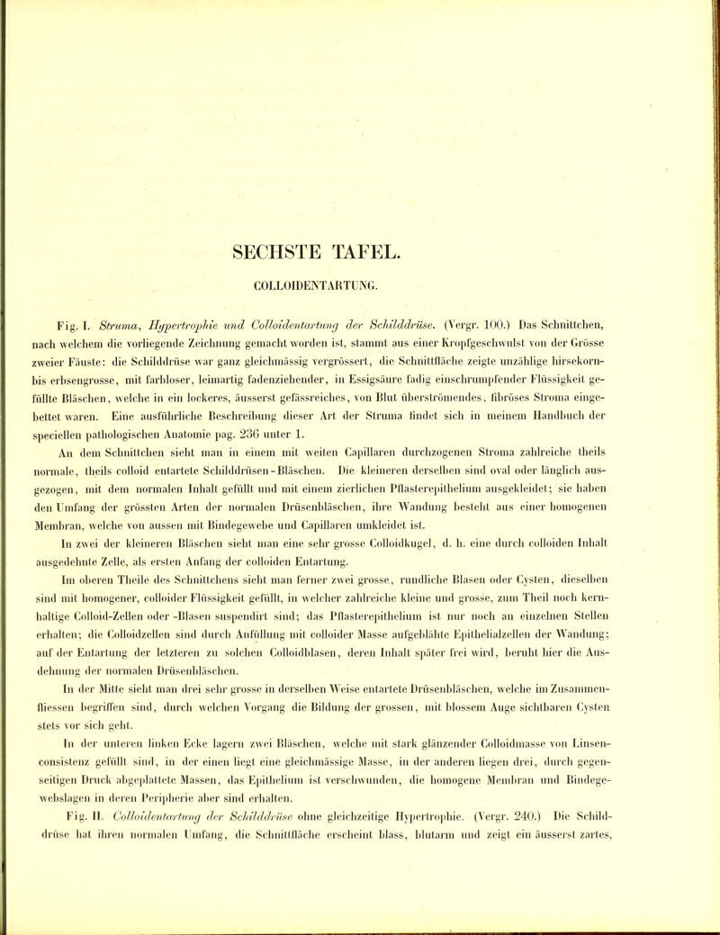 COLLOIDENTARTUNG. Fig. I. Struma, Hypertrophie und Colloidentartung der Schilddrüse. (Vergr. 100.) Das Schnittchen, nach welchem die vorliegende Zeichnung gemacht worden ist, stammt aus einer Kropfgeschwulst von der Grosse zweier Fäuste: die Schilddrüse war ganz gleichmässig vergrössert, die Schnittfläche zeigte unzählige hirsekorn- bis erbsengrosse, mit farbloser, leimartig fadenziehender, in Essigsäure fadig einschrumpfender Flüssigkeit ge- füllte Bläschen, welche in ein lockeres, äusserst gefässreiches, von Blut überströmendes, fibröses Stroma einge- bettet waren. Eine ausführliche Beschreibung dieser Art der Struma findet sich in meinem Handbuch der speciellen pathologischen Anatomie pag. 236 unter 1. An dem Schnittchen sieht man in einem mit weiten Capillaren durchzogenen Stroma zahlreiche tlieils normale, tlieils colloid entartete Schilddrüsen-Bläschen. Die kleineren derselben sind oval oder länglich aus- gezogen, mit dem normalen Inhalt gefüllt und mit einem zierlichen Pflasterepithelium ausgekleidet; sie haben den Umfang der grössten Arten der normalen Drüsenbläschen, ihre Wandung besteht aus einer homogenen Membran, welche von aussen mit Bindegewebe und Capillaren umkleidet ist. In zwei der kleineren Bläschen sieht man eine sehr grosse Colloidkugel, d. h. eine durch colloiden Inhalt ausgedehnte Zelle, als ersten Anfang der colloiden Entartung. Im oberen Theile des Schnittchens sieht man ferner zwei grosse, rundliche Blasen oder Cysten, dieselben sind mit homogener, colloider Flüssigkeit gefüllt, in welcher zahlreiche kleine und grosse, zum Theil noch kern- haltige Colloid-Zellen oder -Blasen suspendirt sind; das Pflasterepithelium ist nur noch an einzelnen Stellen erhalten; die Colloidzellen sind durch Anfüllung mit colloider Masse aufgeblähte Epithelialzellen der Wandung; auf der Entartung der letzteren zu solchen Colloidblasen, deren Inhalt später frei wird, beruht hier die Aus- dehnung der normalen Drüsenbläschen. In der Mitte sieht man drei sehr grosse in derselben Weise entartete Drüsenbläschen, welche im Zusammen- fliessen begriffen sind, durch welchen Vorgang die Bildung der grossen, mit blossem Auge sichtbaren Cysten stets vor sich geht. In der unteren linken Ecke lagern zwei Bläschen, welche mit stark glänzender Colloidmasse von Linsen- consistenz gefüllt sind, in der einen liegt eine gleichmässige Masse, in der anderen liegen drei, durch gegen- seitigen Druck abgeplattete Massen, das Epifhelium ist verschwunden, die homogene Membran und Rindege- webslagen in deren Peripherie aber sind erhalten. Fig. II. Colloidentartung der Schilddrüse ohne gleichzeitige Hypertrophie. (Vergr. 240.) Die Schild- drüse hat ihren normalen Umfang, die Schnittfläche erscheint blass, blutarm und zeigt ein äusserst zartes,