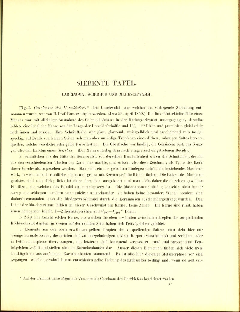 CARCINOMA: SCIRRIIUS UND MARKSCHWAMM. Fig. I. Carcinoma des Unterkiefers.* Die Geschwulst, aus welcher die vorliegende Zeichnung ent- nommen wurde, war von H. Prof. Ried exstirpirt worden. (Jena 23. April 1850.) Die linke Unterkieferhälfte eines Mannes war mit alleiniger Ausnahme des Gelenkköpfchens in der Kerbsgeschwulst untergegangen, dieselbe bildete eine längliche Masse von der Länge der Unterkieferhälfte und 1V2—2 Dicke und prominirte gleichzeitig nach innen und aussen. Ihre Schnittfläche war glatt, glänzend, weissgelblich und anscheinend rein fasrig- speckig, auf Druck von beiden Seiten sah man aber unzählige Tröpfchen eines dicken, rahmigen Saftes hervor- quellen, welche weissliche oder gelbe Farbe hatten. Die Oberfläche war knollig, die Consistenz fest, das Ganze gab also den Habitus eines ScirrJius. (Der Mann unterlag dem nach einiger Zeit eingetretenen Recidiv.) a. Schnittchen aus der Mitte der Geschwulst; von derselben Beschaffenheit waren alle Schnittchen, die ich aus den verschiedensten Theilen des Carcinoms machte, und es kann also diese Zeichnung als Typus des Bau’s dieser Geschwulst angesehen werden. Man sieht ein aus gelockten Bindegewebsbtindeln bestehendes Maschen- werk, in welchem sich rundliche kleine und grosse mit Kernen gefüllte Räume finden. Die Balken des Maschen- gerüstes sind sehr dick; links ist einer derselben ausgefasert und man sieht daher die einzelnen gewellten Fibrillen, aus welchen das Bündel zusammengesetzt ist. Die Maschenräume sind gegenseitig nicht immer streng abgeschlossen, sondern communiciren untereinander, sie haben keine besondere Wand, sondern sind dadurch entstanden, dass die Bindegewebsbündel durch die Kernmassen auseinandergedrängt wurden. Den Inhalt der Maschenräume bilden in dieser Geschwulst nur Kerne, keine Zellen. Die Kerne sind rund, haben einen homogenen Inhalt, 1 -2 Kernkörperchen und 1j300—lj.200y Dchm. b. Zeigt eine Anzahl solcher Kerne, aus welchen die oben erwähnten weisslichen Tropfen des vorquellenden Krebssaftes bestanden, in zweien auf der rechten Seite haben sich Fettkügelchen gebildet. c. Elemente aus den oben erwähnten gelben Tropfen des vorquellenden Saftes; man sieht hier nur wenige normale Kerne, die meisten sind zu unregelmässigen eckigen Körpern verschrumpft und zerfallen, oder in Fettmelamorphose übergegangen, die letzteren sind bedeutend vergrössert, rund und strotzend mit Fett- kügelchen gefüllt und stellen sich als Körnchenhaufen dar. Ausser diesen Elementen finden sich viele freie Fettkügelchen aus zerfallenen Körnchenhaufen stammend. Es ist also hier diejenige Metamorphose vor sich gegangen, welche gewöhnlich eine entschieden gelbe Färbung des Krebssaftes bedingt und, wenn sie weit ver- + Auf der Tafel ist diese Figur aus Versehen als Carcinom des Oberkiefers bezeichnet worden.