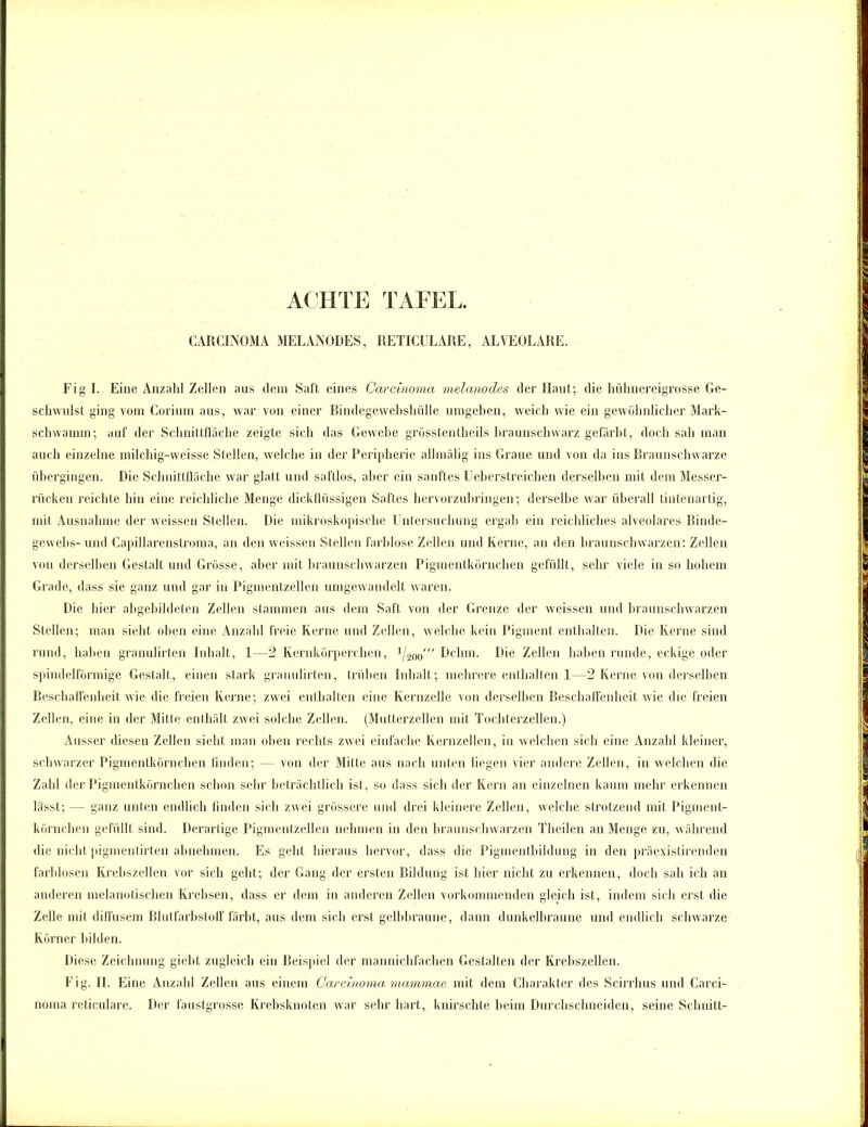 ACHTE TAFEL, CARCINOMA MELANODES, RETICULARE, ALVEOLARE. Figl. Eine Anzahl Zellen aus dem Saft eines Carcinoma melanodes der Haut; die hühnereigrosse Ge- schwulst ging vom Corium aus, war von einer Bindegewebshülle umgehen, weich wie ein gewöhnlicher Mark- schwamm; auf der Schnittfläche zeigte sich das Gewebe grösstentheils braunschwarz gefärbt, doch sah man auch einzelne milchig-weisse Stellen, welche in der Peripherie allmälig ins Graue und von da ins Braunschwarze übergingen. Die Schnittfläche war glatt und saftlos, aber ein sanftes Ueberstreichen derselben mit dem Messer- rücken reichte hin eine reichliche Menge dickflüssigen Saftes hervorzubringen; derselbe war überall tintenartig, mit Ausnahme der weissen Stellen. Die mikroskopische Untersuchung ergab ein reichliches alveolares Binde- gewebs- und Capillarenstroma, an den weissen Stellen farblose Zellen und Kerne, an den braunschwarzen: Zellen von derselben Gestalt und Grösse, aber mit braunschwarzen Pigmentkörnchen gefüllt, sehr viele in so hohem Grade, dass sie ganz und gar in Pigmentzellen umgewandelt waren. Die hier ahgebildeten Zellen stammen aus dem Saft von der Grenze der weissen und braunschwarzen Stellen; man sieht oben eine Anzahl freie Kerne und Zellen, welche kein Pigment enthalten. Die Kerne sind rund, haben granulirten Inhalt, 1—2 Kernkörperchen, 11200' Dehrn. Die Zellen haben runde, eckige oder spindelförmige Gestalt, einen stark granulirten, trüben Inhalt; mehrere enthalten 1—2 Kerne von derselben Beschaffenheit wie die freien Kerne; zwei enthalten eine Kernzelle von derselben Beschaffenheit wie die freien Zellen, eine in der Mitte enthält zwei solche Zellen. (Mutterzellen mit Tochterzellen.) Ausser diesen Zellen sieht man oben rechts zwei einfache Kernzellen, in welchen sich eine Anzahl kleiner, schwarzer Pigmentkörnchen finden; — von der Mitte aus nach unten liegen vier andere Zellen, in welchen die Zahl der Pigmentkörnchen schon sehr beträchtlich ist, so dass sich der Kern an einzelnen kaum mehr erkennen lässt; — ganz unten endlich finden sich zwei grössere und drei kleinere Zellen, welche strotzend mit Pigment- körnchen gefüllt sind. Derartige Pigmentzellen nehmen in den braunschwarzen Theilen an Menge zu, während die nicht pigmentirten abnehmen. Es geht hieraus hervor, dass die Pigmentbildung in den präexistirenden farblosen Krebszellen vor sich geht; der Gang der ersten Bildung ist hier nicht zu erkennen, doch sah ich an anderen melanotischen Krebsen, dass er dem in anderen Zellen vorkommenden gleich ist, indem sich erst die Zelle mit diffusem Blutfarbstoff färbt, aus dem sich erst gelbbraune, dann dunkelbraune und endlich schwarze Körner bilden. Diese Zeichnung giebt zugleich ein Beispiel der mannichfachen Gestalten der Krebszellen. Fig. II. Eine Anzahl Zellen aus einem Carcinoma mammae mit dem Charakter des Scirrhus und Carci- noma reticulare. Der faustgrosse Krebsknoten war sehr hart, knirschte heim Durchschneiden, seine Schnitt-