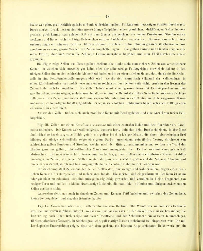 fläche war glatt, grau-röthlich gefärbt und mit zahlreichen gelben Punkten und netzartigen Streifen durchzogen. Durch starken Druck liessen sich eine grosse Menge Tröpfchen eines graulichen, dickflüssigen Saftes hervor- pressen, auch konnte man solchen Saft mit dem Messer abstreichen; die gelben Punkte und Streifen waren trockener und liessen sich als käsige Bröckelchen mit der Nadelspitze hervorheben. Die mikroskopische Unter- suchung zeigte ein sehr eng verfilztes, fibröses Stroma, in welchem diffus, ohne in grössere Maschenräume ein- geschlossen zu sein, grosse Mengen von Zellen eingebettet lagen. Die gelben Punkte und Streifen zeigten die- selbe Textur, aber hier waren die Zellen in Fettmetamorphose begriffen und zum Theil durch diese unter- gegangen. Die Figur zeigt Zellen aus diesen gelben Stellen; oben links sieht man mehrere Zellen von verschiedener Gestalt, in welchen sich entweder gar keine oder nur sehr wenige Fettkügelchen entwickelt haben; in den übrigen Zellen finden sich zahlreiche kleine Fettkügelchen bis zu einer solchen Menge, dass durch sie die Krebs- zelle in eine Fettkörnchenzelle umgewandelt wird, welche sich dann nach Schwund der Zellmembran in einen Körnchenhaufen verwandelt, wie man einen solchen an der rechten Seite sieht. Auch in den Kernen der Zellen finden sich Fettkügelchen. Die Zellen haben meist einen grossen Kern mit Kernkörperchen und den gewöhnlichen, eiweissartigen, molecularen Inhalt; — in einer Zelle auf der linken Seite findet sich eine Tochter- zelle;— in drei Zellen, eine in der Mitte und zwei rechts unten, finden sich Hohlräume, d. h. zu grossen Blasen mit zähem, colloidartigem Inhalt aufgeblähte Kerne; in zwei solchen Hohlräumen haben sich auch Fettkügelchen entwickelt, in einem nicht. Ausser den Zellen finden sich auch zwei freie Kerne mit Fettkügelchen und eine Anzahl von freien Fett- kügelchen. Fig. III. Zellen aus einem Carcinoma mammae mit einer centralen Höhle und dem Charakter des Carci- noma reticulare. Der Knoten war wallnussgross, äusserst hart, knirschte heim Durchschneiden, in der Mitte fand sich eine haselnussgrosse Höhle gefüllt mit gelber bröcklig-käsiger Masse, die einen tuberkelartigen Brei bildete; die übrige Schnittfläche zeigte eine graue Farbe, anscheinend rein fibröse Textur, durchsetzt von zahlreichen gelben Punkten und Streifen, welche nach der Mitte zu Zusammenflüssen, so dass die Wand des Herdes ganz aus gelber, tuberkelähnlicher Masse zusammengesetzt war. Es liess sich nur wenig grauer Saft abstreichen. Die mikroskopische Untersuchung der harten, grauen Stellen zeigte ein fibröses Stroma mit diffus eingelagerten Zellen, die gelben Stellen zeigten die Fasern in Zerfall begriffen und die Zellen in Atrophie und molecularem Zerfall, durch welchen Vorgang offenbar die centrale Höhle bewirkt worden war. Die Zeichnung stellt Zellen aus den gelben Stellen dar, nur wenige sind wohl erhalten, zeigen einen deut- lichen Kern mit Kernkörperchen und molecularen Inhalt. Die meisten sind eingeschrumpft, der Kern ist kaum oder gar nicht zu erkennen, sie sind unregelmässig eckig geworden und zerfallen in kleine Fragmente von eckiger Form und endlich in kleine eiweissartige Moleküle, die man links in Haufen und übrigens zwischen den Zellen zerstreut sieht. Ausserdem sieht man auch in einzelnen Zellen und Kernen Fettkügelchen und zwischen den Zellen freie, kleine Fettkügelchen und einzelne Körnchenhaufen. Fig. IV. Carcinoma alveolare, Gallertkrebs aus dem Rectum. Die Wände der unteren zwei Drittheile des Rectums waren durchaus entartet, so dass sie nur noch aus der 5—6“' dicken Krebsmasse bestanden; die letztere lag nach innen frei, zeigte auf dieser Oberfläche und der Schnittfläche ein äusserst feinmaschiges, fibröses, alveolares Netzwerk, in welches grauliche, gallertartige Masse anscheinend frei eingebettet war. Die mi- kroskopische Untersuchung zeigte, dass von dem groben, mit blossem Auge sichtbaren Balkenwerk aus ein