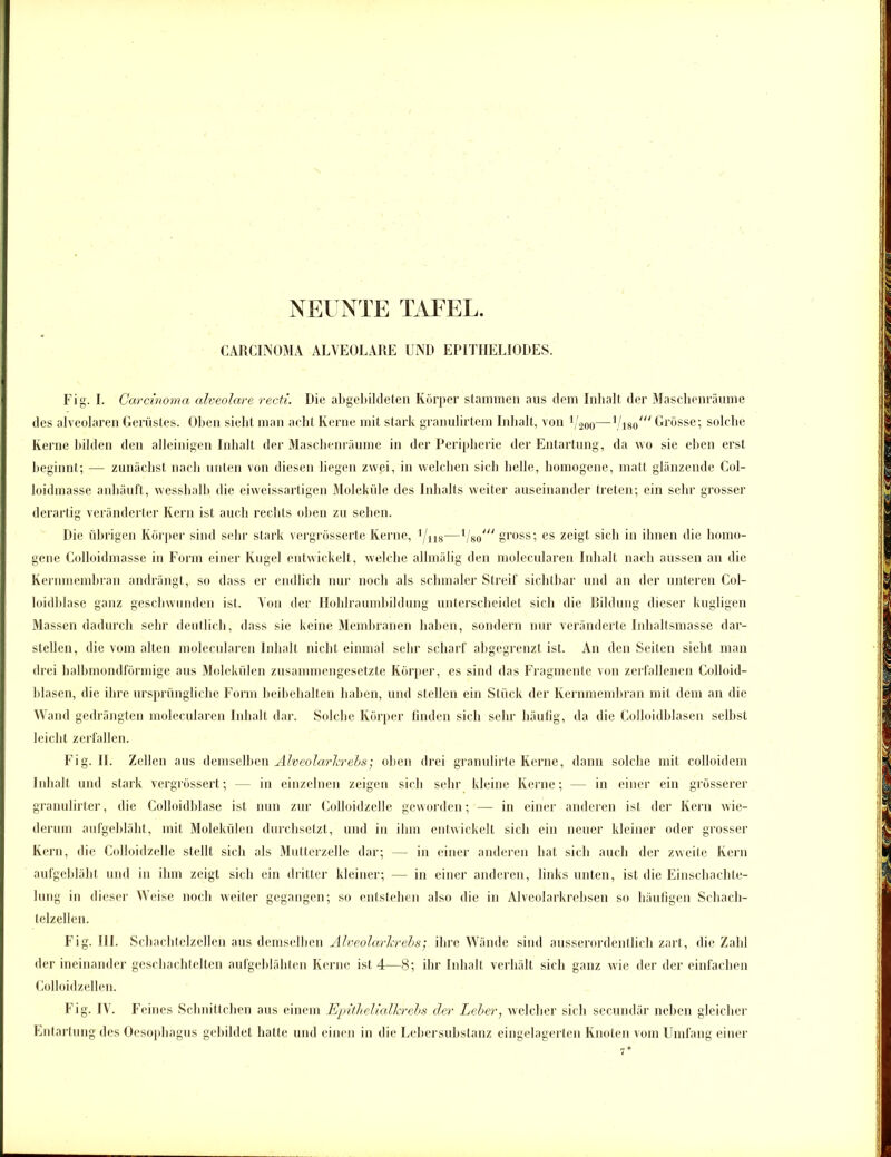NEUNTE TAUT. CARCINOMA ALVEOLARE UND EP1TIIEL10DES. Fig. I. Carcinoma alveolare recti. Die abgebildeten Körper stammen aus dem Inhalt der Maschenräume des alveolaren Gerüstes. Oben sieht man acht Kerne mit stark granulirtem Inhalt, von 1/200—1/i80/// Grösse; solche Kerne bilden den alleinigen Inhalt der Maschenräume in der Peripherie der Entartung, da wo sie eben erst beginnt; — zunächst nach unten von diesen liegen zwei, in welchen sich helle, homogene, matt glänzende Col- loidmasse anhäuft, wesshalb die eiweissartigen Moleküle des Inhalts weiter auseinander treten; ein sehr grosser derartig veränderter Kern ist auch rechts oben zu sehen. Die übrigen Körper sind sehr stark vergrösserte Kerne, l/ns—1/80' gross; es zeigt sich in ihnen die homo- gene Golloidmasse in Form einer Kugel entwickelt, welche allmälig den molecularen Inhalt nach aussen an die Kernmembran andrängt, so dass er endlich nur noch als schmaler Streif sichtbar und an der unteren Col- loidblase ganz geschwunden ist. Von der Hohlraumbildung unterscheidet sich die Bildung dieser kugligen Massen dadurch sehr deutlich, dass sie keine Membranen haben, sondern nur veränderte Inhaltsmasse dar- stellen, die vom alten molecularen Inhalt nicht einmal sehr scharf abgegrenzt ist. An den Seiten sieht man drei halbmondförmige aus Molekülen zusammengesetzte Körper, es sind das Fragmente von zerfallenen Colloid- blasen, die ihre ursprüngliche Form beibehalten haben, und stellen ein Stück der Kernmembran mit dem an die Wand gedrängten molecularen Inhalt dar. Solche Körper finden sich sehr häufig, da die Colloidblasen seihst leicht zerfallen. Fig. II. Zellen aus demselben Alveolarkrebs; oben drei granulirte Kerne, dann solche mit colloidem Inhalt und stark vergrössert; — in einzelnen zeigen sich sehr kleine Kerne; — in einer ein grösserer granulirter, die Colloidblase ist nun zur Colloidzelle geworden; — in einer anderen ist der Kern wie- derum aufgebläht, mit Molekülen durchsetzt, und in ihm entwickelt sich ein neuer kleiner oder grosser Kern, die Colloidzelle stellt sich als Mutterzelle dar; — in einer anderen hat sich auch der zweite Kern aufgebläht und in ihm zeigt sich ein dritter kleiner; — in einer anderen, links unten, ist die Einschachte- lung in dieser Weise noch weiter gegangen; so entstehen also die in Alveolarkrebsen so häufigen Schach- telzellen. Fig. III. Schachtelzellen aus demselben AIveolarlcrebs; ihre Wände sind ausserordentlich zart, die Zahl der ineinander geschachtelten aufgeblähten Kerne ist 4—8; ihr Inhalt verhält sich ganz wie der der einfachen Colloidzellen. Fig. IV. Feines Schnittchen aus einem Epithelialkrebs der Leber, welcher sich secundär neben gleicher Entartung des Oesophagus gebildet hatte und einen in die Lebersubstanz eingelagerten Knoten vom Umfang einer