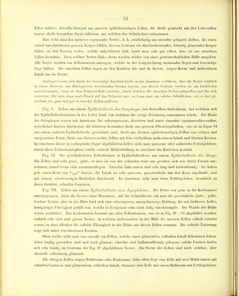 Erbse bildete; derselbe bestand aus grossen epithclienartigen Zellen, die theils gemischt mit den Leberzellen waren, theils besondere Strata bildeten, aus welchen das Schnittchen entnommen. Man sieht zunächst mehrere sogenannte Nester, d. b. zwiebelartig um einander gelagerte Zellen, die einen scharf umschriebenen grossen Körper bilden, dessen Centrum ein durchscheinender, fettartig glänzender Körper bildet; an den Nestern rechts, welche aufgeblättert sind, kann man sehr gut sehen, dass sie aus einzelnen Zellen bestehen. Zwei solcher Nester (links oben) werden wieder von einer gemeinschaftlichen Hülle umgeben. Alle Nester werden von Zellenmassen umzogen, welche in der Längsrichtung aneinander liegen und faserartige Züge bilden. Die einzelnen Zellen ragen an den Rändern hie und da hervor, zeigen Kerne und molecularen Inhalt um die Kerne. Anfänger lassen sieb durch das faserartige Ansehen leicht zu der Annahme verführen, dass die Nester wirklich in einem fibrösen, aus Bindegewebe bestehenden Stroma lagern; von diesem Irrthum werden sie am leichtesten zurückkommen, wenn sie dem Präparat Kali zusetzen, durch welches die einzelnen Zellen aufquellen und für sich vortreten; übt man dann noch Druck auf das Präparat aus, so kann man ein solches Schnittchen, wie es hier ge- zeichnet ist, ganz und gar in einzelne Zellen auflösen. Fig. V. Zeilen aus einem Epithelialkrebs des Oesophagus von demselben Individuum, bei welchem sich der Epithelialkrebsknoten in der Leber fand, von welchem die vorige Zeichnung entnommen wurde. Die Häute des Oesophagus waren mit hirsekorn-bis erbsengrossen, discreten und unter einander zusammenfliessenden, weissliehen Knoten durchsetzt; die letzteren bestanden theils aus grossen Pflasterepithelien, wie sie in Figur VI aus einem anderen Epithelialkrebs gezeichnet sind, theils aus kleinen epithelienartigen Zellen von eckiger und ausgezackter Form, theils aus kleinen ovalen Zellen mit fein vertheiltem molecularen Inhalt und kleinen Kernen. In einzelnen dieser in vorliegender Figur abgebildeten Zellen siebt man sparsame oder zahlreiche Fettkügelchen; durch diese Fettmetamorphose wurde centrale Höhlenbildung in einzelnen der Knötchen bewirkt. Fig. VI. Die gewöhnlichsten Zellenformen in Epithelialkrebsen aus einem Epithelialkrebs der Zunge. Die Zellen sind sehr gross, platt, so dass sie von der schmalen Seite aus gesehen sich wie starre Fasern aus- nehmen, zumal wenn viele zusammenliegen. Einzelne links unten sind sehr lang und keulenförmig. Sie haben jede einen Kern von 1 250' Grösse, ihr Inhalt ist sehr sparsam, grösstentheils um den Kern angehäuft, und mit feinen, eiweissartigen Molekülen durchsetzt. In einzelnen siebt man feine Fettkügelchen, kenntlich an ihren dunklen, scharfen Conturen. Fig. A ll. Zellen aus einem Epithelialkrebs einer Lymphdrüse. Die Drüse war ganz in der Krebsmasse untergegangen, hatte die Grösse einer Haselnuss, auf der Schnittfläche sab man die gewöhnliche glatte, gelbe, trockne Textur, aber in der Mitte fand sich eine erbsengrosse, unregelmässige Höhlung, die mit farbloser, heller, honigartiger Flüssigkeit gefüllt war, welche in Essigsäure sehr stark fadig einschrumpfte. Die Wände der Höhle waren zerklüftet. Der Krebsknoten bestand aus allen Zellenformen, wie sie in Fig. IV—VI abgebildet worden, enthielt sehr viele und grosse Nester, in welchen insbesondere in der Mitte die meisten Zellen colloid entartet waren, so dass offenbar die colloide Flüssigkeit in der Höhle aus diesen Zellen stammte. Die colloide Entartung zeigt sich unter verschiedenen Formen. Oben rechts sieht man eine Anzahl von Zellen, welche einen glänzenden, colloiden Inhalt bekommen haben, daher kuglig geworden sind und stark glänzen; einzelne sind halbmondförmig gebogen; solche Formen finden sich sehr häufig im Centrum der Fig. IV abgebildeten Nester. Die Kerne der Zellen sind noch sichtbar, aber ebenfalls colloidartig glänzend. Alle übrigen Zellen zeigen Hohlräume oder Bruträume; links oben liegt eine Zelle mit zwei Hohlräumen mit scharfen Conturen und glänzendem, colloidem Inhalt, darunter eine Zelle mit einem Hohlraum mit Fettkügelchen.