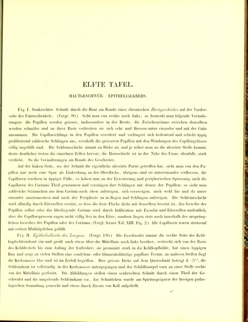 HAUTGESCHWÜR. EPITHELIALKREBS. Fig. I. Senkrechter Schnitt durch die Haut am Rande eines chronischen Hautge$chwürs auf der Vorder- seite des Unterschenkels. (Vergr. 80.) Geht man von rechts nach links, so bemerkt man folgende Verände- rungen: die Papillen werden grösser, insbesondere in der Breite, die Zwischenräume zwischen denselben werden schmäler und an ihrer Basis verbreiten sie sich sehr und lliessen unter einander und mit der Cutis zusammen. Die Capillarschlinge in den Papillen erweitert und verlängert sich bedeutend und schickt üppig proliferirend zahlreiche Schlingen aus, wesshalh die grösseren Papillen mit den Windungen des Capillargefässes völlig angefüllt sind. Die Schleimschicht nimmt an Dicke zu, und je näher man an die ulcerirte Stelle kommt, desto deutlicher treten die einzelnen Zellen hervor; die Hornschicht ist in der Nähe des Uicus ebenfalls stark verdickt. So die Veränderungen am Rande des Geschwürs. Auf der linken Seite, wo der Schnitt die eigentliche ulcerirte Partie getroffen hat, sieht man von den Pa- pillen nur noch eine Spur als Einkerbung an der Oberfläche, übrigens sind sie untereinander verflossen, die Capillaren wuchern in üppiger Fülle, es haben nun an der Erweiterung und peripherischen Sprossung auch die Capillaren des Coriums Theil genommen und vereinigen ihre Schlingen mit denen der Papillen; so sieht man zahlreiche Stämmchen aus dem Gorium nach oben aufsteigen, sich verzweigen, auch wohl hie und da unter einander anastomosiren und nach der Peripherie zu in Bogen und Schlingen aufsteigen. Die Schleimschicht wird allmälig durch Eiterzellen ersetzt, so dass die freie Fläche dicht mit denselben besetzt ist, das Gewebe der Papillen seihst oder das blosliegende Corium wird durch Infiltration mit Exsudat und Eiterzellen undeutlich, aber die Capillarsprossen ragen nicht völlig frei in den Eiter, sondern liegen stets noch innerhalb des ursprüng- lichen Gewebes der Papillen oder des Coriums. (Vergl. ferner Taf. XIII. Fig. 2.) Alle Capillaren waren strotzend mit rothen Blutkügelchen gefüllt. Fig. II. Epithelialkrebs des Larynx. (Vergr. 180.) Die Geschwulst nimmt die rechte Seite der Kehl- kopfschleimhaut ein und greift auch etwas über die Mittellinie nach links herüber, erstreckt sich von der Basis des Kehldeckels bis zum Anfang der Luftröhre; sie prominirt stark in die Kehlkopfhöhle, hat einen lappigen Bau und zeigt an vielen Stellen eine condylom- oder blumenkohlartige papillare Textur, an anderen Stellen liegt die Krebsmasse Idos und ist im Zerfall begriffen. Ihre grösste Dicke auf dem Querschnitt beträgt 4—5', die Schleimhaut ist vollständig in der Krebsmasse untergegangen und der Schildknorpel vorn an einer Stelle rechts von der Mittellinie perforirt. Die Abbildungen stellen einen senkrechten Schnitt durch einen Theil der Ge- schwulst und die umgehende Schleimhaut vor, das Schnittchen wurde am Spirituspräparat der hiesigen patho- logischen Sammlung gemacht und etwas durch Zusatz von Kali aufgehellt.