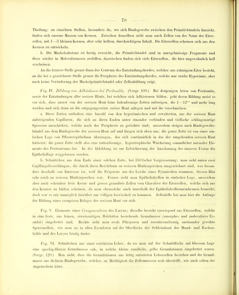 Theilung; an einzelnen Stellen, besonders da, wo sich Bindegewebe zwischen den Primitivbündeln hinzieht, finden sich enorme Massen von Kernen. Zwischen denselben sieht man auch Zellen von der Natur der Eiter- zellen, mit 1—3 kleinen Kernen, aber sehr hellem, durchsichtigem Inhalt. Die Eiterzellen scheinen sich aus den Kernen zu entwickeln. b. Die Muskelsubstanz ist breiig erweicht, die Primitivbündel sind in unregelmässige Fragmente und diese wieder in Molecularmasse zerfallen, dazwischen finden sich viele Eiterzellen, die hier ungewöhnlich bell erscheinen. An die letztere Stelle grenzt dann das Centrum des Entzündungsherdes, welcher aus rahmigem Eiter besteht, an die bei a gezeichnete Stelle grenzt die Peripherie des Entzündungsherdes, welche nur starke Hyperämie, aber noch keine Veränderung der Muskelprimitivbündel oder Zellenbildung zeigt. Fig. IV. Bildung von Adhäsionen hei Peritonitis. (Vergr. 100.) Bei denjenigen Arten von Peritonitis, sowie der Entzündungen aller seröser Häute, bei welchen sich Adhäsionen bilden, gebt deren Bildung meist so vor sich, dass zuerst von der serösen Haut feine fadenförmige Zotten aufsteigen, die 1—12' und mehr lang werden und sich dann an die entgegengesetzte seröse Haut anlegen und mit ihr verschmelzen. a. Diese Zotten enthalten eine Anzahl von den hyperämischen und erweiterten, aus der serösen Haut aufsteigenden Capillaren, die sich an ihren Enden unter einander verbinden und vielfache scldingenartige Sprossen ausschicken, welche nach der Peripherie zu gerichtet sind; ausserdem steigen auch Bindegewebs- bündel aus dem Bindegewebe der serösen Haut auf und biegen sich oben um; die ganze Zotte ist von einer ein- fachen Lage von Pflasterepithelium überzogen, das sich continuirlich in das der umgebenden serösen Haut fortsetzt; die ganze Zotte stellt also eine zottenförmige, hypertrophische Wucherung sämmtlicher normaler Ele- mente des Peritoneums dar. In der Abbildung ist zur Erleichterung der Anschauung der inneren Textur die Epitheliallage weggclassen worden. b. Schnittchen aus dem Ende einer solchen Zotte, bei 350 facher Vergrösserung; man siebt unten zwei Capillargefässschlingen, die durch ihren Reicht hum an weissen Blutkörperchen ausgezeichnet sind, was beson- ders desshalb von Interesse ist, weil die Präparate aus der Leiche eines Pyämischen stammen, dessen Blut sehr reich an weissen Blutkörperchen war. Ferner sieht man Epithelialzellen in einfacher Lage, ausserdem aber auch scheinbar freie Kerne und grosse granulirte Zellen vom Charakter der Eiterzellen, welche sich aus den Kernen zu bilden scheinen, da man ebensolche auch innerhalb der Epillielialzellenmembranen bemerkt; doch war es mir unmöglich hierüber zur völligen Gewissheit zu kommen. Jedenfalls bat inan hier die Anfänge der Bildung eines croupösen Beleges der serösen Haut vor sich. Fig. V. Elemente einer Croupmembran des Larynx; dieselbe bestellt vorwiegend aus Eiterzellen, welche in eine feste, aus feinen, eiweissartigen Molekülen bestehende Gründmasse (amorphes und moleculares Ex- sudat) eingebettet sind. Rechts siebt man ovale Pilzsporen und rosenkranzförmig aneinander gereihte Sporenzellen, wie man sie in allen Exsudaten auf der Oberfläche der Schleimhaut der Mund- und Rachen- höhle und des Larynx häufig findet. Fig. VI. Schnittchen aus einer scirrhösen Leber, da ivo man auf der Schnittfläche mit blossem Auge eine speckig-fibröse Grundmasse sah, in welche kleine rundliche, gelbe Granulationen eingebettet waren. (Vergr. 120.) Man sieht, dass die Granulationen aus fettig entarteten Leberzellen bestehen und die Grund- masse aus dichtem Bindegewebe, welches an Mächtigkeit die Zellenmassen weit übertrifft, wie auch schon der Augenschein lehrt.