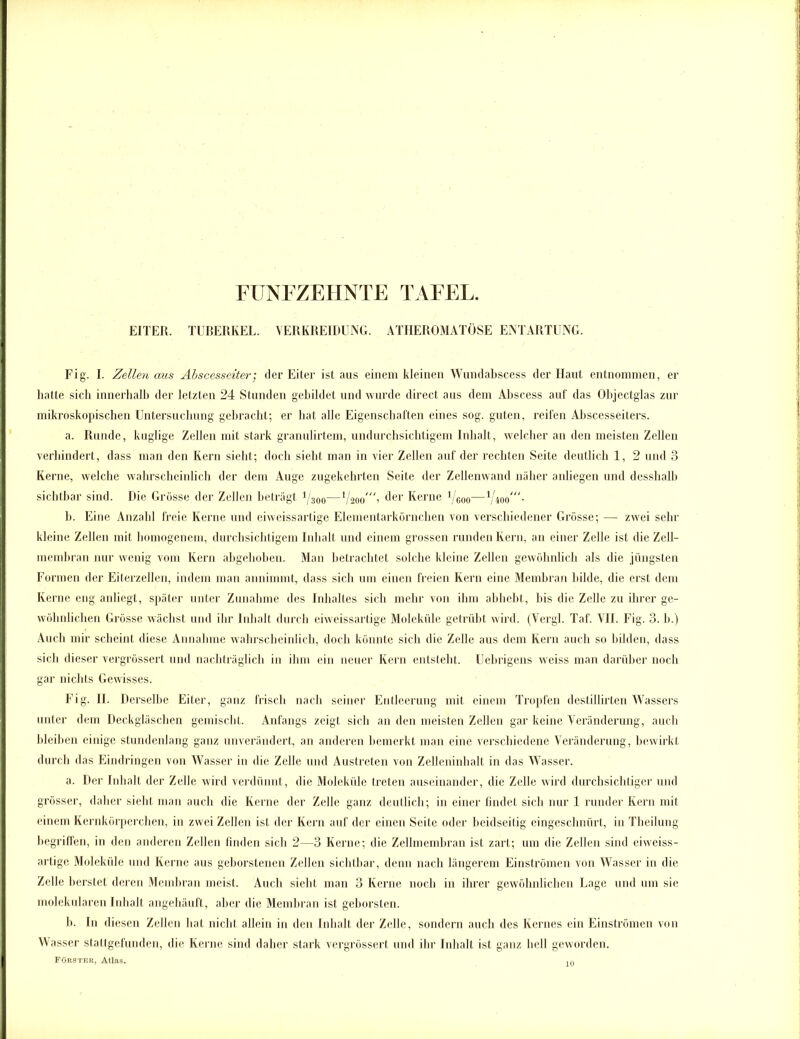 FÜNFZEHNTE TAFEL EITER. TUBERKEL. VERKREIDUNG. ATHEROMATÖSE ENTARTUNG. Fig. I. Zellen ans Äbscesseiter; der Eiter ist aus einem kleinen Wundabscess der Haut entnommen, er hatte sich innerhalb der letzten 24 Stunden gebildet und wurde direct aus dem Abscess auf das Objectglas zur mikroskopischen Untersuchung gebracht; er hat alle Eigenschaften eines sog. guten, reifen Abscesseiters. a. Runde, kuglige Zellen mit stark granulirtem, undurchsichtigem Inhalt, welcher an den meisten Zellen verhindert, dass man den Kern sieht; doch sieht man in vier Zellen auf der rechten Seite deutlich 1, 2 und 3 Kerne, welche wahrscheinlich der dem Auge zugekehrten Seite der Zellenwand näher anliegen und desshalb sichtbar sind. Die Grösse der Zellen beträgt 1j300—Vaoo^'i c'er Kerne Ygoo— b. Eine Anzahl freie Kerne und eiweissartige Elementarkörnchen von verschiedener Grösse; — zwei sehr kleine Zellen mit homogenem, durchsichtigem Inhalt und einem grossen runden Kern, an einer Zelle ist die Zell- membran nur wenig vom Kern abgehoben. Man betrachtet solche kleine Zellen gewöhnlich als die jüngsten Formen der Eiterzellen, indem man annimmt, dass sich um einen freien Kern eine Membran bilde, die erst dem Kerne eng anliegt, später unter Zunahme des Inhaltes sich mehr von ihm abhebt, bis die Zelle zu ihrer ge- wöhnlichen Grösse wächst und ihr Inhalt durch eiweissartige Moleküle getrübt wird. (Vergl. Taf. VII. Fig. 3. b.) Auch mir scheint diese Annahme wahrscheinlich, doch könnte sich die Zelle aus dem Kern auch so bilden, dass sieb dieser vergrössert und nachträglich in ihm ein neuer Kern entsteht. Uebrigens weiss man darüber noch gar nichts Gewisses. Fig. II. Derselbe Eiter, ganz frisch nach seiner Entleerung mit einem Tropfen desti11 irten Wassers unter dem Deckgläschen gemischt. Anfangs zeigt sich an den meisten Zellen gar keine Veränderung, auch bleiben einige stundenlang ganz unverändert, an anderen bemerkt man eine verschiedene Veränderung, bewirkt durch das Eindringen von Wasser in die Zelle und Austreten von Zelleninhalt in das Wasser. a. Der Inhalt der Zelle wird verdünnt, die Moleküle treten auseinander, die Zelle wird durchsichtiger und grösser, daher sieht man auch die Kerne der Zelle ganz deutlich; in einer findet sich nur 1 runder Kern mit einem Kernkörperchen, in zwei Zellen ist der Kern auf der einen Seite oder beidseitig eingeschnürt, in Theilung begriffen, in den anderen Zellen finden sich 2—3 Kerne; die Zellmembran ist zart; um die Zellen sind eiweiss- artige Moleküle und Kerne aus geborstenen Zellen sichtbar, denn nach längerem Einströmen von Wasser in die Zelle berstet deren Membran meist. Auch siebt man 3 Kerne noch in ihrer gewöhnlichen Lage und um sie molekularen Inhalt angehäuft, aber die Membran ist geborsten. b. In diesen Zellen bat nicht allein in den Inhalt der Zelle, sondern auch des Kernes ein Einströmen von Wasser stattgefunden, die Kerne sind daher stark vergrössert und dir Inhalt ist ganz bell geworden. Förster, Atlas. 10