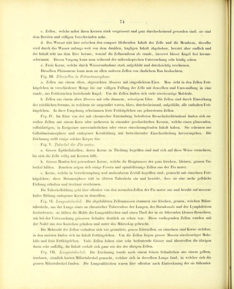 ) c. Zellen, welche nebst ihren Kernen stark vergrössert und ganz durchscheinend geworden sind; sie sind dem Bersten und völligen Verschwinden nahe. d. Das Wasser tritt hier zwischen den compact bleibenden Inhalt der Zelle und die Membran, dieselbe wird durch das Wasser anfangs weit von dem dunklen, kugligen Inhalt abgehoben, berstet aber endlich und der Inhalt tritt aus dem Riss heraus, worauf die Zellmembran als runde, äusserst blasse Kugel frei herum- schwimmt. Diesen Vorgang kann man während der mikroskopischen Untersuchung sehr häufig sehen. e. Freie Kerne, welche durch Wasseraufnahme stark.aufgebläht und durchsichtig erschienen. Dieselben Phänomene kann man an allen anderen Zellen von ähnlichem Bau beobachten. Fig. 111. Eiterzellen in Fettmetamorphose. a. Zellen aus einem alten, abgesackten Abscess mit eingedicktem Eiter. Man sieht in den Zellen Fett- kügelchen in verschiedener Menge bis zur völligen Füllung der Zelle mit denselben und Umwandlung in eine runde, aus Fettkörnchen bestehende Kugel. Um die Zellen finden sieb viele eiweissartige Moleküle. b. Zellen aus einem alten Abscess mit sehr dünnem, wässrigem Eiter. Die Zellen sind durch Einwirkung des reichlichen Serums, in welchem sie suspendirt waren, blass, durchscheinend, aufgebläht, alle enthalten Fett- kügelchen. In ihrer Umgebung schwimmen freie Fettkügelchen aus geborstenen Zellen. Fig. IV. Im Eiter von der mit chronischer Entzündung behafteten Bronchialschleimhaut finden sich zu- weilen Zellen mit einem Kern oder mehreren in einander geschachtelten Kernen, welche einen glänzenden, colloidartigcn, in Essigsäure unveränderlichen oder etwas einschrumpfenden Inhalt haben. Sie scheinen aus Colloidmetamorphose und endogener Kernbildung mit fortwährender Einschachtelung hervorzugehen. Die Zeichnung stellt einige solcher Körper dar. Fig. V. Tuberkel der Pia mater. a. Grosse Epithelialzellen, deren Kerne in Theilung begriffen sind und sich auf diese Weise vermehren, bis sich die Zelle völlig mit Kernen füllt. b. Grosse Haufen frei gewordener Kerne, welche die Hauptmasse der ganz frischen, kleinen, grauen Tu- berkel bilden. Daneben zeigen sich einige Fasern und spindelförmige Zellen aus der Pia mater. c. Kerne, welche in Verschrumpfung und molecuiarem Zerfall begriffen sind, gemischt mit einzelnen Fett- kügelchen; diese Metamorphose tritt in älteren Tuberkeln ein und bewirkt, dass sie eine mehr gelbliche Färbung erhalten und trockner erscheinen. Die Tuberkelbildung gebt liier offenbar von den normalen Zellen der Pia mater aus und beruht auf massen- hafter Bildung endogener Kerne in denselben. Fig. VI. Lungentuberkel. Die abgebildeten Zellenmassen stammen aus frischen, grauen, weichen Miliar- tuberkeln, aus der Lunge eines an chronischer Tuberculose der Lungen, des Darmkanals und der Lymphdrüsen Gestorbenen; sie füllten die Höhle der Lungenbläschen und einen Theil der in sie führenden kleinen Bronchien, wie bei der Untersuchung grösserer Schnitte deutlich zu sehen war. Diese vorliegenden Zellen wurden mit der Nadel aus den Knötchen gehoben und unter das Mikroskop gebracht. Die Mehrzahl der Zellen verhalten sich wie granulirte, grosse Eiterzellen, an einzelnen sind Kerne sichtbar, in den meisten finden sich im Inhalt Fettkügelchen. Um die Zellen liegen grosse Massen eiweissartiger Mole- küle und freie Fettkügelchen. Viele Zellen haben eine sehr bedeutende Grösse und übertreffen die übrigen darin sehr auffällig, ihr Inhalt verhält sich ganz wie der der übrigen Zellen. Fig. VII. Lungentuberkel. Die Zeichnung wurde nach einem feinen Schnittchen aus einem gelben, trocknen, ziemlich barten Miliartuberkel gemacht, welcher sich in derselben Lunge fand, in welcher sich die grauen Miliartuberkel fanden. Die Lungenbläschen waren hier offenbar nach Eintrocknung der sie füllenden
