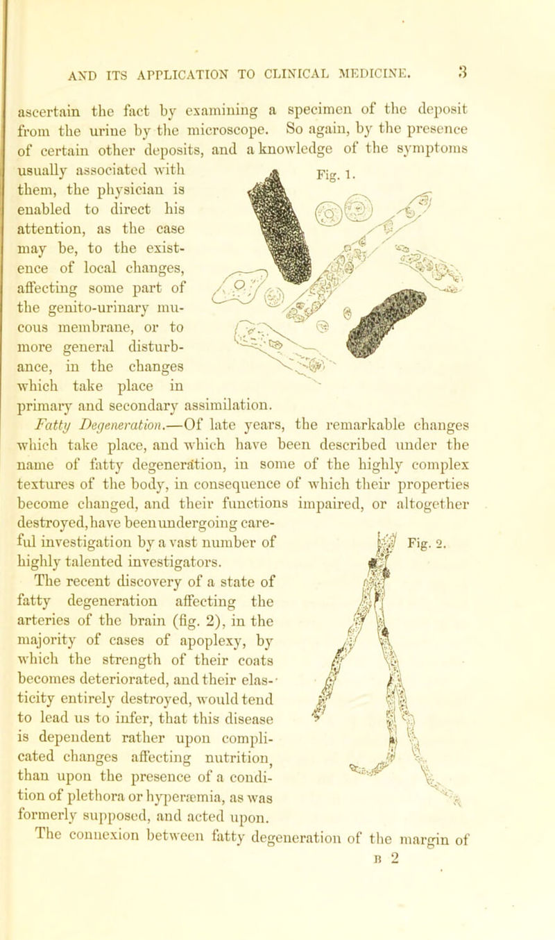 Fig. 1. ascertain the fact by examining a specimen of the deposit from the urine by the microscope. So again, by the presence of certain other deposits, and a knowledge of the symptoms usually associated with them, the physician is enabled to direct his attention, as the case may be, to the exist- ence of local changes, affecting some part of the genito-urinary mu- cous membrane, or to more general disturb- ance, in the changes which take place in primary and secondary assimilation. Fatty Degeneration.—Of late years, the remarkable changes which take place, and which have been described under the name of fatty degeneration, in some of the highly complex textures of the body, in consequence of which their properties become changed, and their functions impaired, or altogether destroyed, have beenimdergoing care- fid investigation by a vast number of highly talented investigators. The recent discovery of a state of fatty degeneration affecting the arteries of the brain (fig. 2), in the majority of cases of apoplexy, by which the strength of their coats becomes deteriorated, and their elas- • ticity entirely destroyed, would tend to lead us to infer, that this disease is dependent rather upon compli- cated changes affecting nutritioiq than upon the presence of a condi- tion of plethora or hypersemia, as was formerly supposed, and acted upon. The connexion between fatty degeneration of the margin of