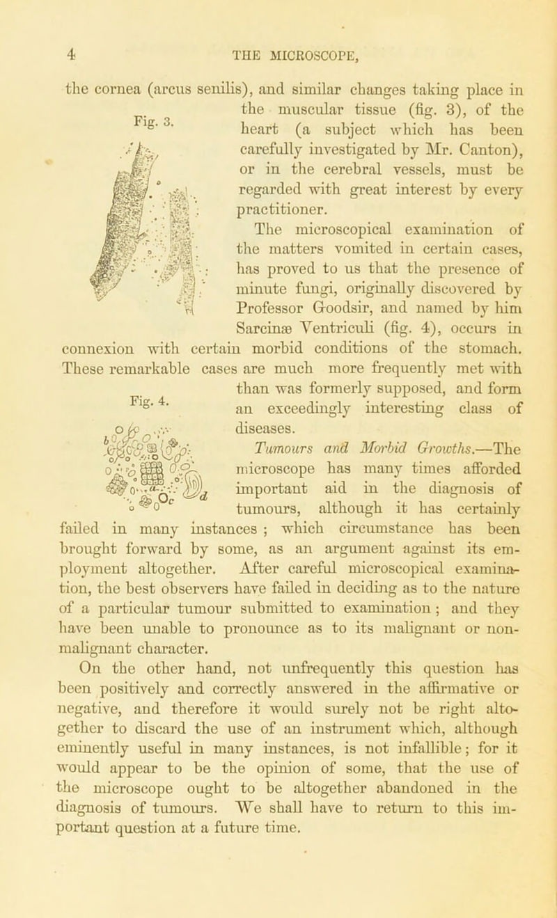 the cornea (arcus senilis), and similar changes taking place in the muscular tissue (fig. 3), of the heart (a subject which has been carefully investigated by Mr. Canton), or in the cerebral vessels, must be regarded with great interest by every practitioner. The microscopical examination of the matters vomited in certain cases, has proved to us that the presence of minute fungi, originally discovered by Professor Gloodsir, and named by him Sarcinas Yentriculi (fig. 4), occurs in connexion with certain morbid conditions of the stomach. These remarkable cases are much more frequently met with than was formerly supposed, and form an exceedingly interesting class of diseases. Tumours and Morbid Growths.—The microscope has many times afforded important aid in the diagnosis of tumours, although it has certainly failed in many instances ; which circumstance has been brought forward by some, as an argument against its em- ployment altogether. After careful microscopical examina- tion, the best observers have failed in deciding as to the nature of a particular tumour submitted to examination; and they have been unable to pronounce as to its malignant or non- malignant character. On the other hand, not unfrequently this question has been positively and correctly answered in the affirmative or negative, and therefore it would surely not be right alto- gether to discard the use of an instrument which, although eminently useful in many instances, is not infallible; for it would appear to be the opinion of some, that the use of the microscope ought to be altogether abandoned in the diagnosis of tumours. We shall have to return to this im- portant question at a future time.