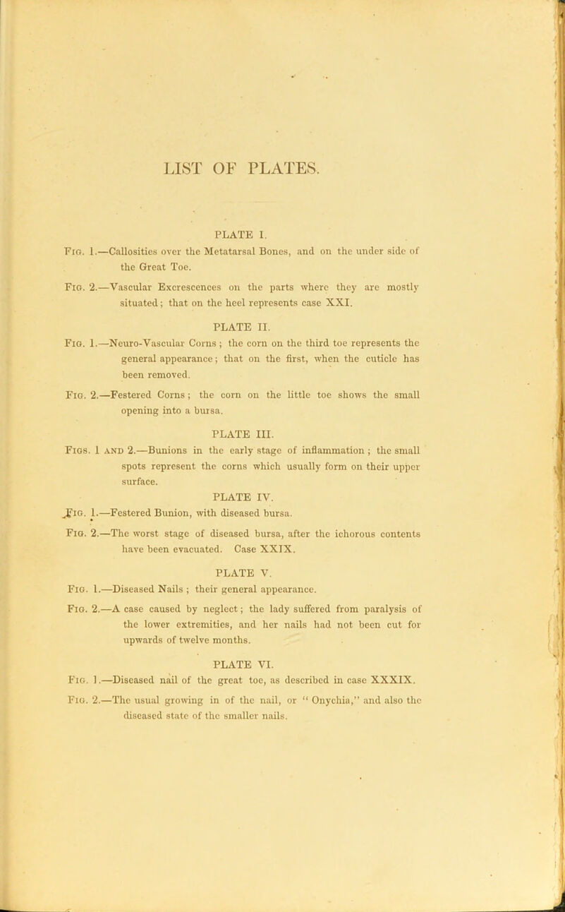 LIST OF PLATES. PLATE I. Fro. 1.—Callosities over the Metatarsal Bones, and on the under side of the Great Toe. Fio. 2.—Vascular Excrescences on the parts where they are mostly situated; that on the heel represents case XXI. PLATE II. Fio. 1.—Neuro-Vascular Corns ; the corn on the third toe represents the general appearance; that on the first, when the cuticle has been removed. Fio. 2.—Festered Corns; the corn on the little toe shows the small opening into a bursa. PLATE III. Figs. 1 and 2.—Bunions in the early stage of inflammation ; the small spots represent the corns which usually form on their upper surface. PLATE IV. „Fio. 1.—Festered Bunion, with diseased bursa. Fig. 2.—The worst stage of diseased bursa, after the ichorous contents have been evacuated. Case XXIX. PLATE V. Fig. 1.—Diseased Nails ; their general appearance. Fig. 2.—A case caused by neglect; the lady suffered from paralysis of the lower extremities, and her nails had not been cut for upwards of twelve months. PLATE VI. Fig. 1.—Diseased nail of the great toe, as described in case XXXIX. Fig. 2.—The usual growing in of the nail, or “ Onychia,” and also the diseased state of the smaller nails.