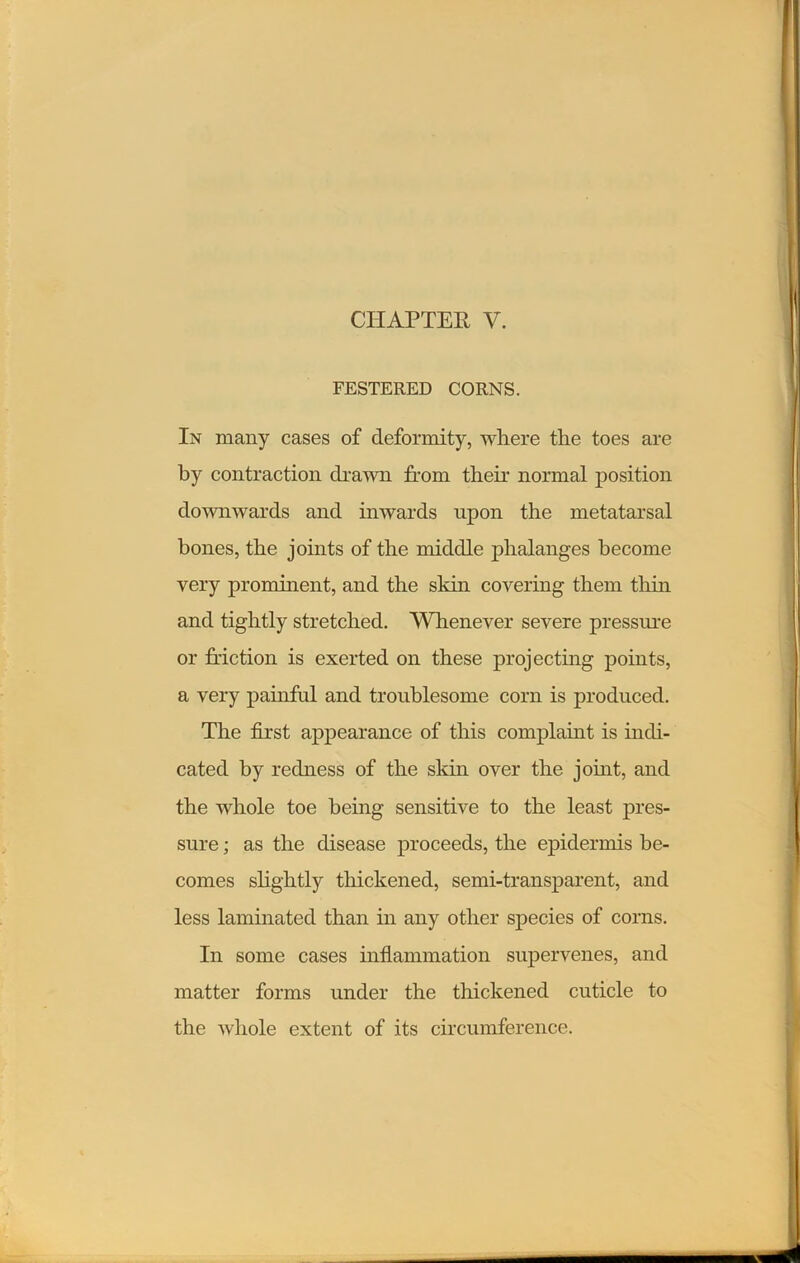 FESTERED CORNS. In many cases of deformity, where the toes are by contraction drawn from their normal position downwards and inwards upon the metatarsal bones, the joints of the middle phalanges become very prominent, and the skin covering them thin and tightly stretched. Whenever severe pressure or friction is exerted on these projecting points, a very painful and troublesome corn is produced. The first appearance of this complaint is indi- cated by redness of the skin over the joint, and the whole toe being sensitive to the least pres- sure ; as the disease proceeds, the epidermis be- comes slightly thickened, semi-transparent, and less laminated than in any other species of corns. In some cases inflammation supervenes, and matter forms under the thickened cuticle to the whole extent of its circumference.