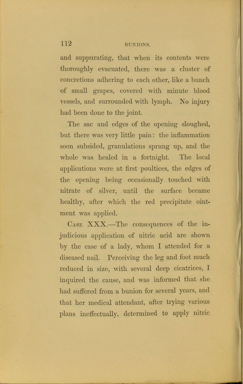 and suppurating, that when its contents were thoroughly evacuated, there was a cluster of concretions adhering to each other, like a bunch of small grapes, covered with minute blood vessels, and surrounded with lymph. No injury had been done to the joint. The sac and edges of the opening sloughed, but there was very little pain: the inflammation soon subsided, granulations sprung up, and the whole was healed in a fortnight. The local applications were at first poultices, the edges of the opening being occasionally touched with nitrate of silver, until the surface became healthy, after which the red precipitate oint- ment was applied. Case XXX.—The consequences of the in- judicious application of nitric acid are shown by the case of a lady, whom I attended for a diseased nail. Perceiving the leg and foot much reduced in size, with several deep cicatrices, I inquired the cause, and was informed that she had suffered from a bunion for several years, and that her medical attendant, after trying various plans ineffectually, determined to apply nitric