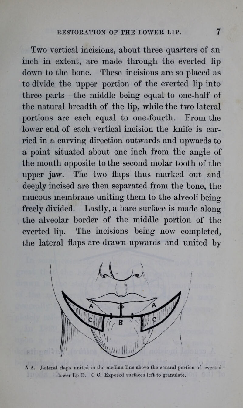 Two vertical incisions, about three quarters of an inch in extent, are made through the everted lip down to the bone. These incisions are so placed as to divide the upper portion of the everted lip into three parts—the middle being equal to one-half of the natural breadth of the lip, while the two lateral portions are each equal to one-fourth. Erom the lower end of each vertical incision the knife is car- ried in a curving direction outwards and upwards to a point situated about one inch from the angle of the mouth opposite to the second molar tooth of the upper jaw. The two flaps thus marked out and deeply incised are then separated from the bone, the mucous membrane uniting them to the alveoli being freely divided. Lastly, a bare surface is made along the alveolar border of the middle portion of the everted lip. The incisions being now completed, the lateral flaps are drawn upwards and united by A A. Lateral flaps united in the median line above the central portion of everted lower lip 13. C C. Exposed surfaces left to granulate.