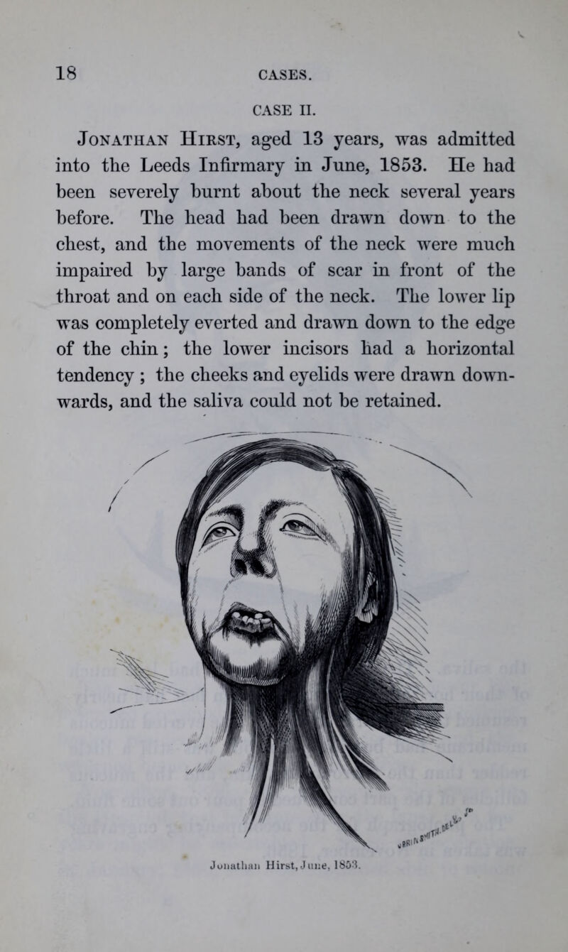 CASE II. Jonathan Hirst, aged 13 years, was admitted into the Leeds Infirmary in June, 1853. He had been severely burnt about the neck several years before. The head had been drawn down to the chest, and the movements of the neck were much impaired by large bands of scar in front of the throat and on each side of the neck. The lower lip was completely everted and drawn down to the edge of the chin; the lower incisors had a horizontal tendency ; the cheeks and eyelids were drawn down- wards, and the saliva could not be retained. Jonathan Hirst,June, 1853.