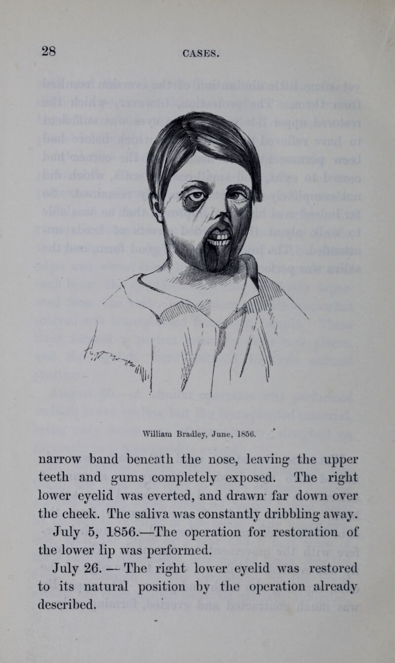 William Bradley, June, lh5(i. narrow band beneath the nose, leaving the upper teeth and gums completely exposed. The right lower eyelid was everted, and drawn far down over the cheek. The saliva was constantly dribbling away. July 5, 1856.—The operation for restoration of the lower lip was performed. July 26. — The right lower eyelid was restored to its natural position by the operation already described.