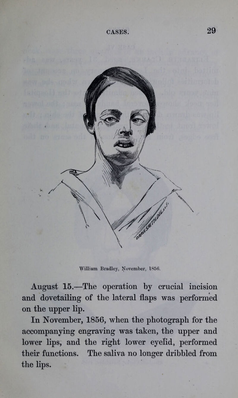 William Bradley, November, IH56. August 15.—The operation by crucial incision and dovetailing of the lateral flaps was performed on the upper lip. In November, 1856, when the photograph for the accompanying engraving was taken, the upper and lower lips, and the right lower eyelid, performed their functions. The saliva no longer dribbled from the lips.