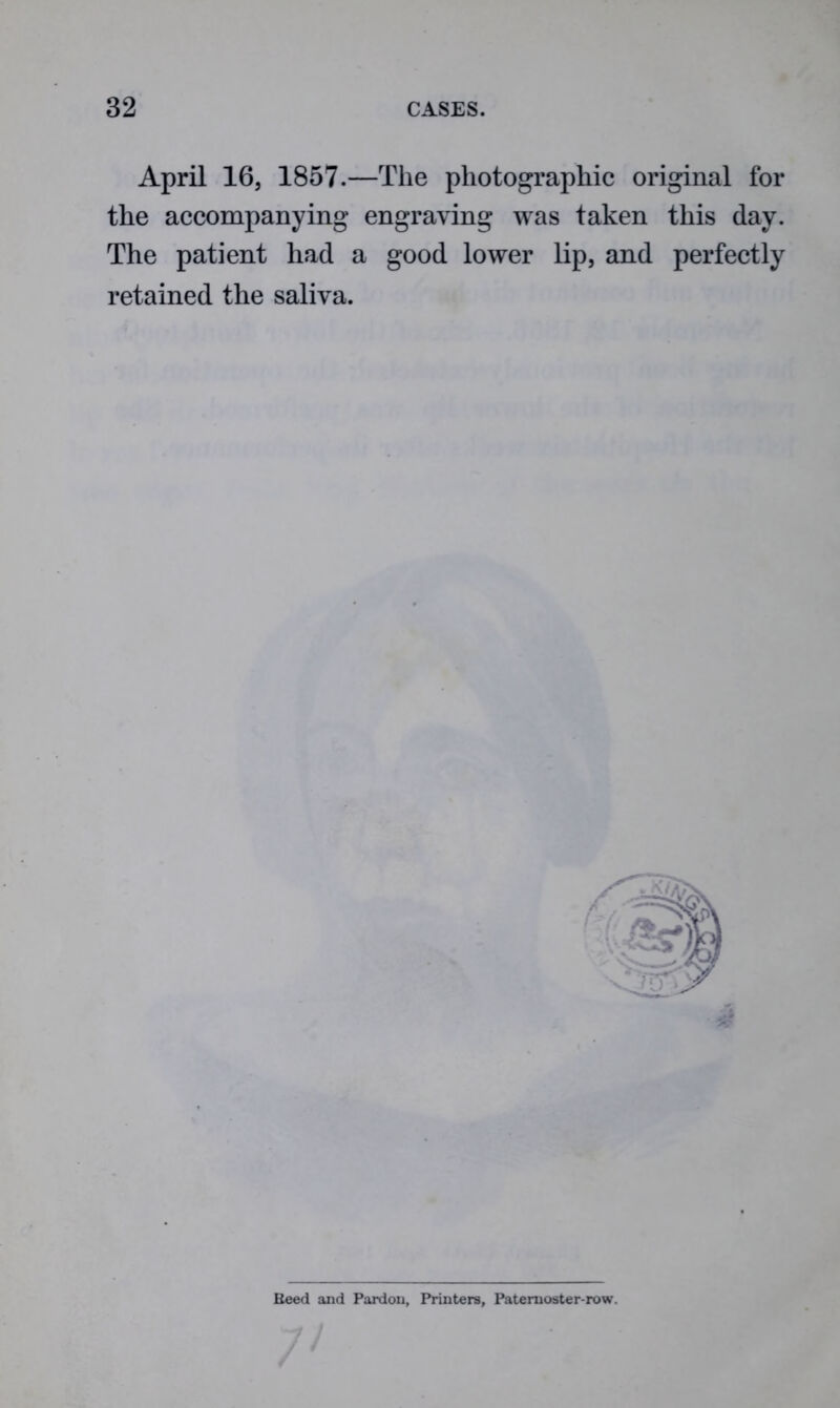 April 16, 1857.—The photographic original for the accompanying engraving was taken this day. The patient had a good lower lip, and perfectly retained the saliva. Keed and Pardon, Printers, Paternoster-row. / /