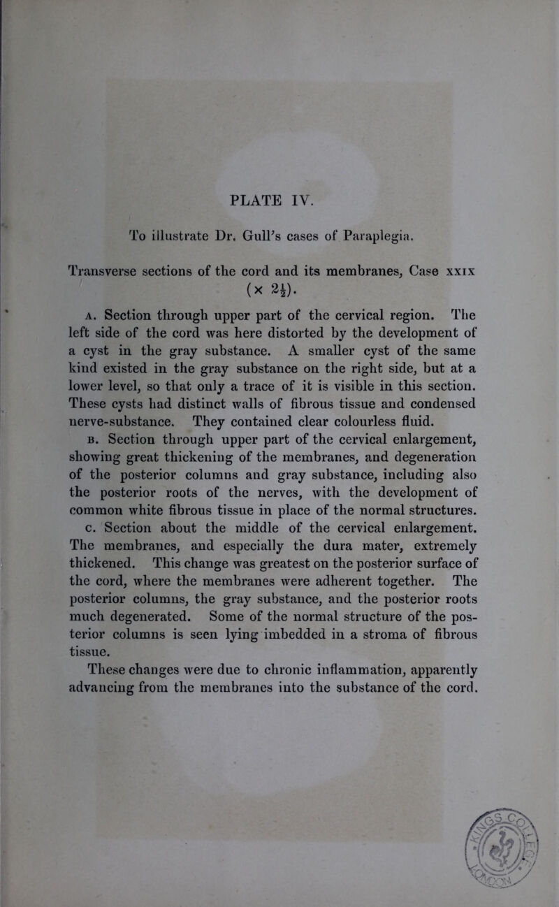 To illustrate Dr. GulPs cases of Paraplegia. Transverse sections of the cord and its membranes, Case xxix (x 2i). a. Section through upper part of the cervical region. The left side of the cord was here distorted by the development of a cyst in the gray substance. A smaller cyst of the same kind existed in the gray substance on the right side, but at a lower level, so that only a trace of it is visible in this section. These cysts had distinct walls of fibrous tissue and condensed nerve-substance. They contained clear colourless fluid. b. Section through upper part of the cervical enlargement, showing great thickening of the membranes, and degeneration of the posterior columns and gray substance, including also the posterior roots of the nerves, with the development of common white fibrous tissue in place of the normal structures. c. Section about the middle of the cervical enlargement. The membranes, and especially the dura mater, extremely thickened. This change was greatest on the posterior surface of the cord, where the membranes were adherent together. The posterior columns, the gray substance, and the posterior roots much degenerated. Some of the normal structure of the pos- terior columns is seen lying imbedded in a stroma of fibrous tissue. These changes were due to chronic inflammation, apparently advancing from the membranes into the substance of the cord.