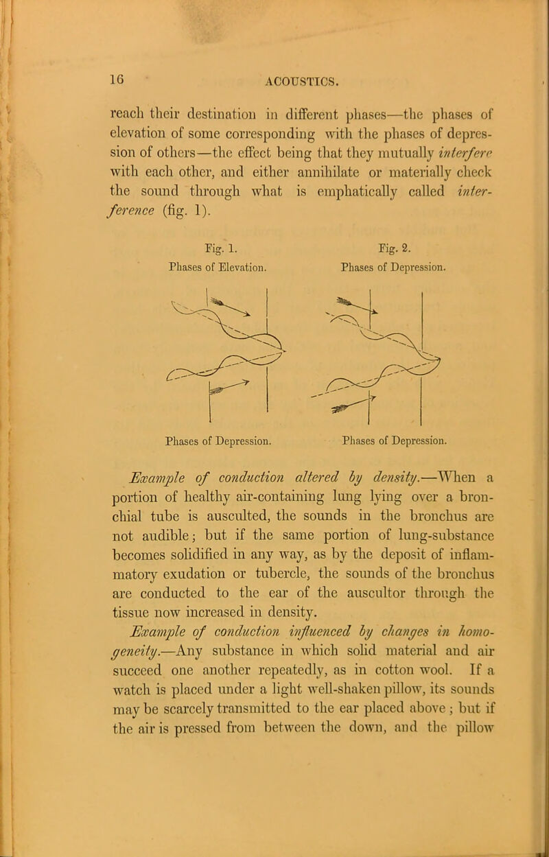 reach their destination in different phases—the phases of elevation of some corresponding with the phases of depres- sion of others—the effect being that they mutually interfere with each other, and either annihilate or materially check the sound through what is emphatically called inter- ference (fig. 1). Fig. 1. Phases of Elevation. Phases of Depression. Eig. 2. Phases of Depression. Phases of Depression. Example of conduction altered by density.—When a portion of healthy air-containing lung lying over a bron- chial tube is ausculted, the sounds in the bronchus are not audible; but if the same portion of lung-substance becomes solidified in any way, as by the deposit of inflam- matory exudation or tubercle, the sounds of the bronchus are conducted to the ear of the auscultor through the tissue now increased in density. Example of conduction influenced by changes in homo- geneity.—Any substance in which solid material and air succeed one another repeatedly, as in cotton wool. If a watch is placed under a light well-shaken pillow, its sounds may be scarcely transmitted to the ear placed above ; but if the air is pressed from between the down, and the pillow