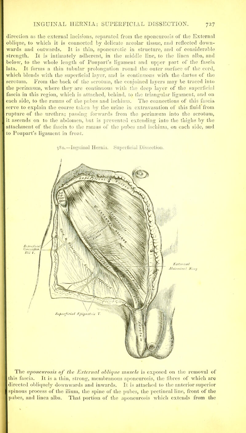 direction as the external incisions, separated from the aponeurosis of the External oblique, to which it is connected by delicate areolar tissue, and reflected down- wards and outwards. It is thin, aponeurotic in structure, and of considerable strength. It is intimately adherent, in the middle line, to the linea alba, and below, to the whole length of Poupart’s ligament and upper part of the fascia lata. It forms a thin tubular prolongation round the outer surface of the cord, which blends with the superficial layer, and is continuous with the dartos of the scrotum. From the back of the scrotum, the conjoined layers may be traced into the perinseum, where they are continuous with the deep layer of the superficial fascia in this region, which is attached, behind, to the triangular ligament, and on each side, to the ramus of the pubes and ischium. The connections of this fascia serve to explain the course taken by the urine in extravasation of this fluid from rupture of the urethra; passing forwards from the per in a; urn into the scrotum, it ascends on to the abdomen, but is prevented extending into the thighs by the attachment of the fascia to the ramus of the pubes and ischium, on each side, and to Poupart’s ligament in front. 380.—Inguinal Hernia. Superficial Dissection. I The aponeurosis of the External oblique muscle is exposed on the removal of this fascia. It is a thin, strong, membranous aponeurosis, the fibres of which are I directed obliquely downwards and inwards. It is attached to the anterior superior I spinous process of the ilium, the sjiine of the pubes, the pectineal line, front of the I pubes, and linea alba. That portion of the aponeurosis which extends from the Ri/UJ