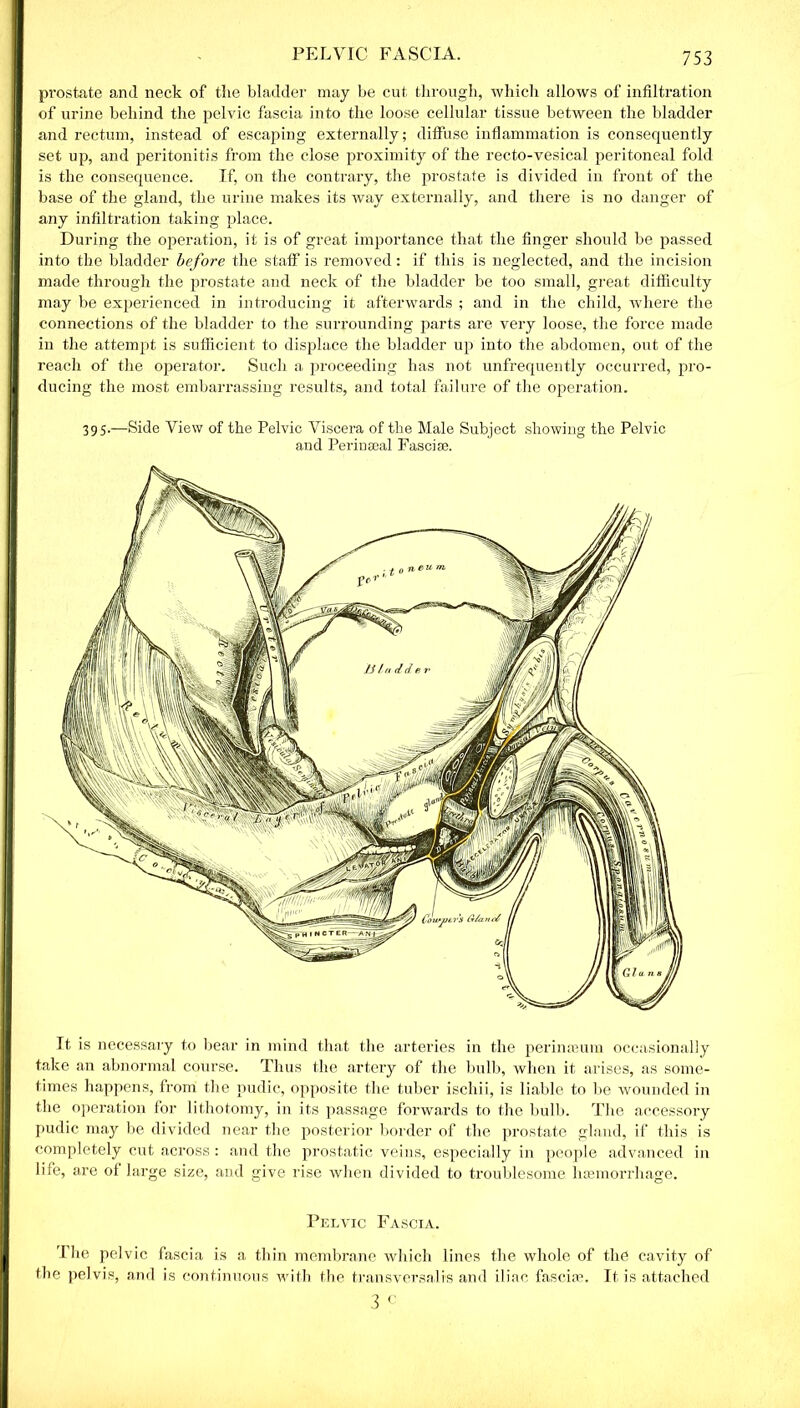 prostate and neck of the bladder may be cut through, which allows of infiltration of urine behind the pelvic fascia into the loose cellular tissue between the bladder and rectum, instead of escaping externally; diffuse inflammation is consequently set up, and peritonitis from the close proximity of the recto-vesical peritoneal fold is the consequence. If, on the contrary, the prostate is divided in front of the base of the gland, the urine makes its way externally, and there is no danger of any infiltration taking place. During the operation, it is of great importance that the finger should be passed into the bladder before the staff is removed: if this is neglected, and the incision made through the prostate aud neck of the bladder be too small, great difficulty may be experienced in introducing it afterwards ; and in the child, where the connections of the bladder to the surrounding parts are very loose, the force made in the attempt is sufficient to displace the bladder up into the abdomen, out of the reach of the operator. Such a proceeding has not unfrequently occurred, pro- ducing the most embarrassing results, and total failure of the operation. 395.—Side View of the Pelvic Viscera of the Male Subject showing the Pelvic and Perinseal Fasciae. It is necessary to bear in mind that the arteries in the perinasum occasionally take an abnormal course. Thus the artery of the bulb, when it arises, as some- times happens, from the pudic, opposite the tuber ischii, is liable to be wounded in the operation for lithotomy, in its passage forwards to the bulb. The accessory pudic may be divided near the posterior border of the prostate gland, if this is completely cut across: and the prostatic veins, especially in people advanced in life, are of large size, and give rise when divided to troublesome haemorrhage. Pelvic Fascia. The pelvic fascia is a thin membrane which lines the whole of the cavity of the pelvis, and is continuous with the transversalis and iliac fasciae. It is attached 3 c