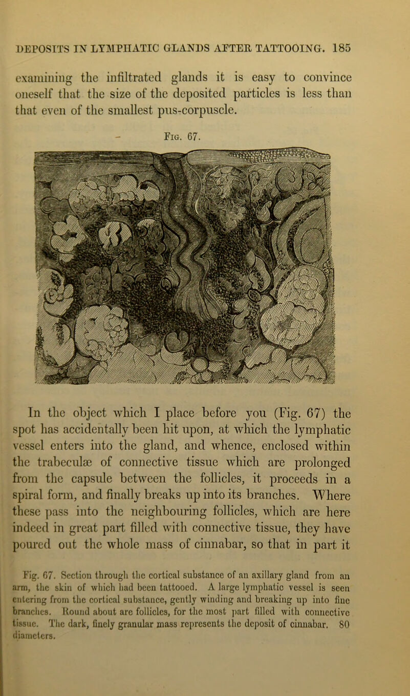 examining the infiltrated glands it is easy to convince oneself that the size of the deposited particles is less than that even of the smallest pus-corpuscle. Fig. 67. In the object which I place before you (Fig. 67) the spot has accidentally been hit upon, at which the lymphatic vessel enters into the gland, and whence, enclosed within the trabeculae of connective tissue which are prolonged from the capside between the follicles, it proceeds in a spiral form, and finally breaks up into its branches. Where these ])ass into the neighbouring follicles, which are here indeed in great part filled with connective tissue, they have poured out the whole mass of cinnabar, so that in part it Fig. 07. Section througli the cortical substance of an axillary gland from an arm, the skin of which had been tattooed. A large lymphatic vessel is seen entering from the cortical substance, gently winding and breaking up into fine branches. Round about are follicles, for the most part filled with connective tissue. The dark, fluely granular mass represents the deposit of cinnabar. 80 diameters.