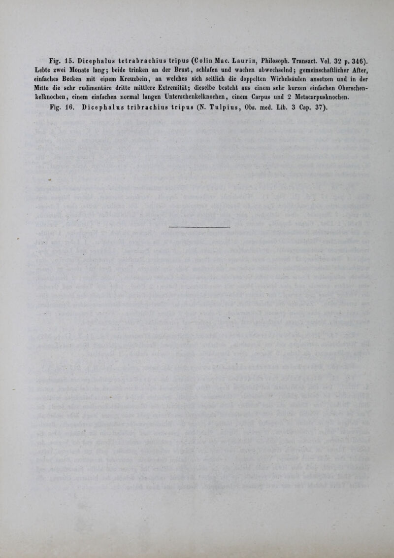 Fig. 15. Dicephalus tetrabrachius tripus (Colin Mac. Laurin, Philosoph. Transact. Vol. 32 p. 346). Lebte zwei Monate lang; beide trinken an der Brust, schlafen und wachen abwechselnd; gemeinschaftlicher After, einfaches Becken mit einem Kreuzbein, an welches sich seitlich die doppelten Wirbelsäulen ansetzen und in der Mitte die sehr rudimentäre dritte mittlere Extremität; dieselbe besteht aus einem sehr kurzen einfachen Oberschen- kelknochen, einem einfachen normal langen Untcrschenkelknochcn, einem Carpus und 2 Metacarpusknochen. Fig. 16. Dicephalus tribrachius tripus (N. Tulpius, Obs. med. Lib. 3 Cap. 37).