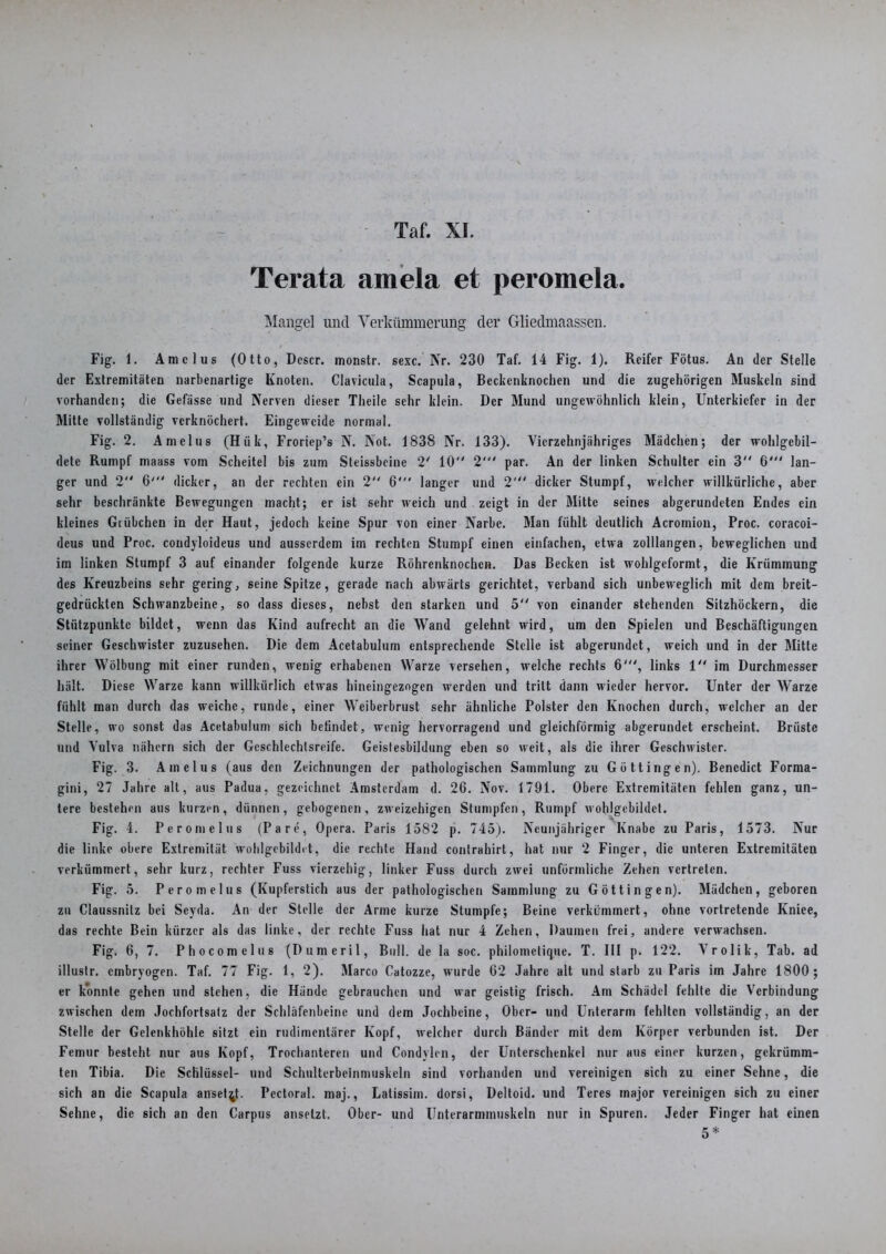 Terata amela et peromela. Mangel und Verkümmerung der Gliedmaassen. Fig. 1. Amclus (Otto, Dcscr. monstr. sexc. Nr. 230 Taf. 14 Fig. 1). Reifer Fötus. An der Stelle der Extremitäten narbenartige Knoten. Clavicula, Scapula, Beckenknochen und die zugehörigen Muskeln sind vorhanden; die Gefässe und Nerven dieser Theile sehr klein. Der Mund ungewöhnlich klein, Unterkiefer in der Mitte vollständig verknöchert. Eingeweide normal. Fig. 2. Am eins (Hiik, Froriep’s N. Not. 1838 Nr. 133). Vierzehnjähriges Mädchen; der wohlgcbil- dete Rumpf maass vom Scheitel bis zum Steissbeine 2' 10 2' par. An der linken Schulter ein 3 6' lan- ger und 2 6' dicker, an der rechten ein 2 6' langer und 2' dicker Stumpf, welcher willkürliche, aber sehr beschränkte Bewegungen macht; er ist sehr weich und zeigt in der Mitte seines abgerundeten Endes ein kleines Giübchen in der Haut, jedoch keine Spur von einer Narbe. Man fühlt deutlich Acroinion, Proc. coracoi- deus und Proc. coudyloideus und ausserdem im rechten Stumpf einen einfachen, etwa zolllangen, beweglichen und im linken Stumpf 3 auf einander folgende kurze Röhrenknochen. Das Becken ist wohlgeformt, die Krümmung des Kreuzbeins sehr gering, seine Spitze, gerade nach abwärts gerichtet, verband sich unbeweglich mit dem breit- gedrückten Schwanzbeine, so dass dieses, nebst den starken und 5 von einander stehenden Sitzhöckern, die Stützpunkte bildet, wenn das Kind aufrecht an die Wand gelehnt wird, um den Spielen und Beschäftigungen seiner Geschwister zuzusehen. Die dem Acetabulum entsprechende Stelle ist abgerundet, weich und in der Mitte ihrer Wölbung mit einer runden, wenig erhabenen Warze versehen, welche rechts 6', links 1 im Durchmesser hält. Diese Warze kann willkürlich etwas hineingezogen werden und tritt dann wieder hervor. Unter der Warze fühlt man durch das weiche, runde, einer Weiberbrust sehr ähnliche Polster den Knochen durch, welcher an der Stelle, wo sonst das Acetabulum sich befindet, wenig hervorragend und gleichförmig abgerundet erscheint. Brüste und Vulva nähern sich der Geschlechtsreife. Geistesbildung eben so weit, als die ihrer Geschwister. Fig. 3. Amelus (aus den Zeichnungen der pathologischen Sammlung zu Göttingen). Benedict Forma- gini, 27 Jahre alt, aus Padua, gezeichnet Amsterdam d. 26. Nov. 1791. Obere Extremitäten fehlen ganz, un- tere bestehen aus kurzen, dünnen, gebogenen, zweizeiligen Stumpfen, Rumpf wohjgebildct. Fig. 4. Peromelus (Pa re, Opera. Paris 1582 p. 745). Neunjähriger Knabe zu Paris, 1573. Nur die linke obere Extremität wohlgcbildet, die rechte Hand contrahirt, hat nur 2 Finger, die unteren Extremitäten verkümmert, sehr kurz, rechter Fuss vierzehig, linker Fuss durch zwei unförmliche Zehen vertreten. Fig. 5. Peromelus (Kupferstich aus der pathologischen Sammlung zu Göttin gen). Mädchen, geboren zu Claussnilz bei Seyda. An der Stelle der Arme kurze Stumpfe; Beine verkümmert, ohne vortretende Kniee, das rechte Bein kürzer als das linke, der rechte Fuss hat nur 4 Zehen, Daumen frei, andere verwachsen. Fig. 6, 7. Phocomelus (Dumeril, Bull, de la soc. philometique. T. III p. 122. Vrolik, Tab. ad illustr. embryogen. Taf. 77 Fig. 1, 2). Marco Catozze, wurde 62 Jahre alt und starb zu Paris im Jahre 1800; er konnte gehen und stehen, die Hunde gebrauchen und war geistig frisch. Am Schädel fehlte die Verbindung zwischen dem Jochfortsatz der Schläfenbeine und dem Jochbeine, Ober- und Unterarm fehlten vollständig, an der Stelle der Gclenkhöhle sitzt ein rudimentärer Kopf, welcher durch Bänder mit dem Körper verbunden ist. Der Femur besteht nur aus Kopf, Trochanteren und Condylen, der Unterschenkel nur aus einer kurzen, gekrümm- ten Tibia. Die Schlüssel- und Schulterbeinmuskeln sind vorhanden und vereinigen sich zu einer Sehne, die sich an die Scapula anset^. Pectoral. maj., Latissim. dorsi, Deltoid. und Teres major vereinigen sich zu einer Sehne, die sich an den Carpus anselzt. Ober- und Unterarmmuskeln nur in Spuren. Jeder Finger hat einen 5 *