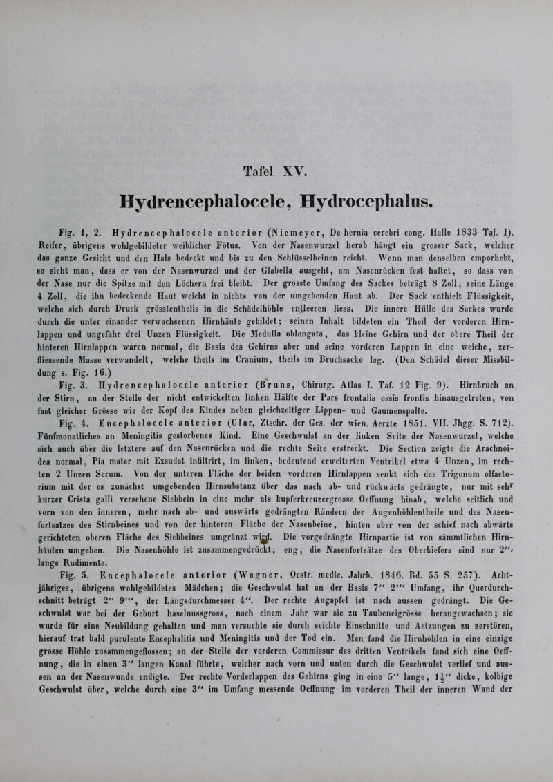 Hydrencephalocele, Hydroceplialus. Fig. 1, 2. Hydrencephalocele anterior (Niemeyer, De hernia ccrebri cong. Halle 1833 Taf. I). Reifer, übrigens wohlgebildcler weiblicher Fötus. Von der Nasenwurzel herab hängt ein grosser Sack, welcher das ganze Gesicht und den Hals bedeckt und bis zu den Schlüsselbeinen reicht. Wenn man denselben emporhebt, so sicht man, dass er von der Nasenwurzel und der Glabella ausgeht, am Nasenrücken fest haftet, so dass von der Nase nur die Spitze mit den Löchern frei bleibt. Der grösste Umfang des Sackes beträgt 8 Zoll, seine Länge 4 Zoll, die ihn bedeckende Haut weicht in nichts von der umgebenden Haut ab. Der Sack enthielt Flüssigkeit, welche sich durch Druck grösstcnthcils in die Schädelhöhle entleeren liess. Die innere Hülle des Sackes wurde durch die unter einander verwachsenen Hirnhäute gebildet; seinen Inhalt bildeten ein Thcil der vorderen Hirn- lappen und ungefähr drei Unzen Flüssigkeit. Die Medulla oblongata, das kleine Gehirn und der obere Theil der hinteren Hirnlappen waren normal, die Basis des Gehirns aber und seine vorderen Lappen in eine weiche, zer- fliessende Masse verwandelt, welche theils im Cranium, theils im Bruchsacke lag. (Den Schädel dieser Missbil- dung s. Fig. 16.) Fig. 3. Hydrencephalocele anterior (Bruns, Chirurg. Atlas I. Taf. 12 Fig. 9). Hirnbruch an der Stirn, an der Stelle der nicht entwickelten linken Hälfte der Pars frontalis ossis frontis hinausgetreten, von fast gleicher Grösse wie der Kopf des Kindes neben gleichzeitiger Lippen- und Gaumenspalte. Fig. 4. E nc e p h al o c e 1 e anterior (Clar, Ztschr. der Ges. der Wien. Aerzte 1851. VII. Jhgg. S. 712). Fünfmonatliches an Meningitis gestorbenes Kind. Eine Geschwulst an der linken Seite der Nasenwurzel, welche sich auch über die letztere auf den Nasenrücken und die rechte Seite erstreckt. Die Section zeigte die Arachnoi- dea normal, Pia matcr mit Exsudat infiltrirt, im linken, bedeutend erweiterten Ventrikel etwa 4 Unzen, im rech- ten 2 Unzen Serum. Von der unteren Fläche der beiden vorderen Hirnlappen senkt sich das Trigonum olfacto- rium mit der cs zunächst umgebenden Hirnsubstanz über das nach ab- und rückwärts gedrängte, nur mit sehr kurzer Crista galli versehene Siebbein in eine mehr als kupferkreuzergrosse Oeffnung hinab, welche seitlich und vorn von den inneren, mehr nach ab- und auswärts gedrängten Rändern der Augenhöhlentheile und des Nasen- fortsatzes des Stirnbeines und von der hinteren Fläche der Nasenbeine, hinten aber von der schief nach abwärts gerichteten oberen Fläche des Siebbeines umgränzt wijjjl. Die vorgedrängte Hirnpartie ist von sämmtlichen Hirn- häuten umgeben. Die Nasenhöhle ist zusammengedrückt, eng, die Nasenfortsälze des Oberkiefers sind nur 2< lange Rudimente. Fig. 5. E n c ep h a 1 o c e 1 e anterior (Wagner, Oestr. mcdic. Jahrb. 1846. Bd. 55 S. 257). Acht- jähriges, übrigens wohlgebildetes Mädchen; die Geschwulst hat an der Basis 7 2' Umfang, ihr Querdurch- schnilt beträgt 2 9', der Längsdurchmesscr 4. Der rechte Augapfel ist nach aussen gedrängt. Die Ge- schwulst war bei der Geburt haselnussgross, nach einem Jahr war sie zu Taubcneigrössc herangewachsen; sie wurde für eine Neubildung gehalten und man versuchte sie durch seichte Einschnitte und Actzungen zu zerstören, hierauf trat bald purulente Encephalitis und Meningitis und der Tod ein. Man fand die Hirnhöhlen in eine einzige grosse Höhle zusammengeflossen; an der Stelle der vorderen Commissur des dritten Ventrikels fand sich eine Oeff- nung, die in einen 3 langen Kanal führte, welcher nach vorn und unten durch die Geschwulst verlief und aus- sen an der Nasenwunde endigte. Der rechte Vorderlappen des Gehirns ging in eine 5 lange, 1J-'' dicke, kolbige Geschwulst über, welche durch eine 3 im Umfang messende Oeffnung im vorderen Theil der inneren Wand der