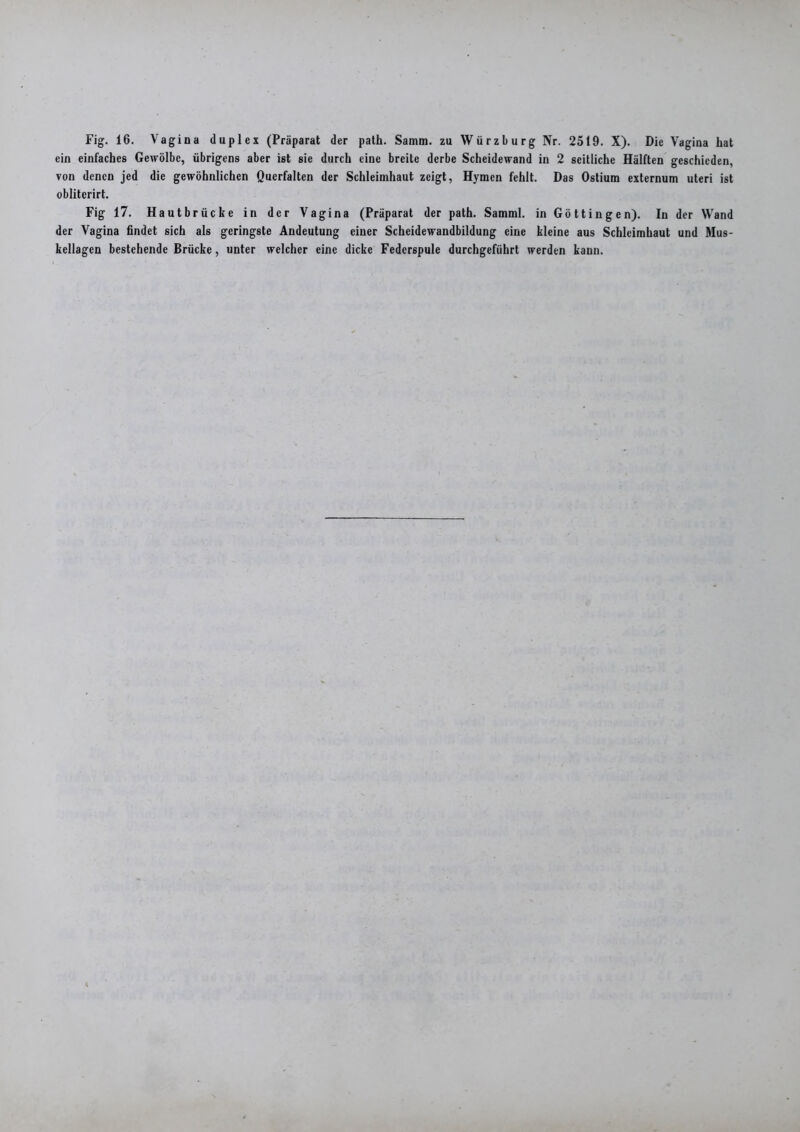 Fig. 16. Vagina duplex (Präparat der path. Samm. zu Würzburg Nr. 2519. X). Die Vagina hat ein einfaches Gewölbe, übrigens aber ist sie durch eine breite derbe Scheidewand in 2 seitliche Hälften geschieden, von denen jed die gewöhnlichen Qucrfalten der Schleimhaut zeigt, Hymen fehlt. Das Ostium externum uteri ist obliterirt. Fig 17. Hautbrücke in der Vagina (Präparat der path. Samml. in Göttin gen). In der Wand der Vagina findet sich als geringste Andeutung einer Scheidewandbildung eine kleine aus Schleimhaut und Mus- kellagen bestehende Brücke, unter welcher eine dicke Federspule durchgeführt werden kann.