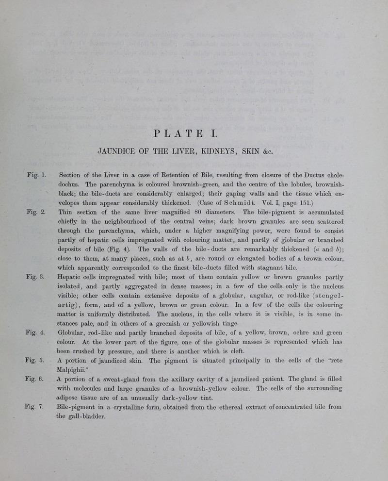 PLATE I. JAUNDICE OF THE LIVER, KIDNEYS, SKIN &c. Fig. 1. Section of the Liver in a case of Retention of Bile, resulting from closure of the Ductus chole- dochus. The parenchyma is coloured brownish-green, and the centre of the lobules, brownish- black; the bile-ducts are considerably enlarged; their gaping walls and the tissue which en- velopes them appear considerably thickened. (Case of Schmidt. Vol. I, page 151.) Fig. 2. Thin section of the same liver magnified 80 diameters. The bile-pigment is accumulated chiefly in the neighbourhood of the central veins; dark brown granules are seen scattered through the parenchyma, which, under a higher magnifying power, were found to consist partly of hepatic cells impregnated with colouring matter, and partly of globular or branched deposits of bile (Fig. 4). The walls of the bile - ducts are remarkably thickened (ct and b); close to them, at many places, such as a,t b, are round or elongated bodies of a brown colour, which apparently corresponded to the finest bile-ducts filled with stagnant bile. Fig. 3. Hepatic cells impregnated with bile; most of them contain yellow or brown granules partly isolated, and partly aggregated in dense masses; in a few of the cells only is the nucleus visible; other cells contain extensive deposits of a globular, angular, or rod-like (stengel- artig), foi'm, and of a j’^eUow, bx’own or green colour. In a few of the cells the colouring matter is uniformly distributed. The nucleus, in the cells where it is visible, is in some in- stances pale, and in others of a greenish or yellowish tinge. Fig. 4. Globular, rod-like and partly branched deposits of bile, of a yellow, brown, ochre and gi’een colour. At the lower part of the figure, one of the globular masses is represented which lias been crushed by pressure, and there is another which is cleft. Fig. 5. A portion of jaundiced skin. The pigment is situated principally in the cells of the “rete Malpighii.” Fig. 6. A poi'tion of a sweat-gland from the axillary cavity of a jaundiced patient. The gland is filled with molecules and large granules of a brownish-yellow colour. The cells of the surrounding adipose tissue are of an unusually dark-yellow tint. Fig. 7. Bile-pigment in a crystalline form, obtained from the ethereal extract of concentrated bile from the gall-bladder.