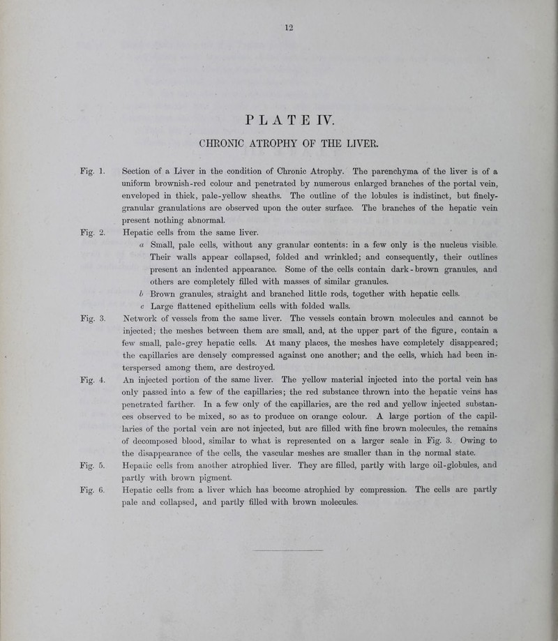 Fig. 1. Fig. 2. Fig. 3. Fig. 4. Fig. 5. Fig. 6. P L A T E IV. CHRONIC ATROPHY OF THE LIVER. Section of a Liver in the condition of Chronic Atrophy. The parenchyma of the liver is of a uniform brownish-red colour and penetrated by numerous enlarged branches of the portal vein, enveloped in thick, pale-yellow sheaths. The outline of the lobules is indistinct, but finely- granular granulations are observed upon the outer surface. The branches of the hepatic vein present nothing abnormal. Hepatic cells from the same liver. a Small, pale cells, without any granular contents: in a few only is the jmcleus visible. Their walls appear collapsed, folded and wrinkled; and consequently, their outlines present an indented appearance. Some of the cells contain dark-brown gi’anules, and others are completely filled with masses of similar granules. h Brown granules, straight and branched little rods, together with hepatic cells, c Large flattened epithelium cells with folded walls. Network of vessels from the same liver. The vessels contain brown molecules and cannot be injected; the meshes between them are small, and, at the upper part of the figure, contain a few small, pale-grey hepatic cells. At many places, the meshes have completely disappeared; the capillaries are densely compressed against one another; and the cells, which had been in- terspersed among them, are destroyed. An injected portion of the same liver. The yellow material injected into the portal vein has only passed into a few of the capillaries; the red substance thrown into the hepatic veins has penetrated farther. In a few only of the capillaries, are the red and yellow injected substan- ces observed to be mixed, so as to produce on orange colour. A large portion of the capil- laries of the portal vein are not injected, but are flUed with flne brown molecules, the remains of decomposed blood, similar to what is represented on a larger scale in Fig. 3. Owing to the disappearance of the cells, the vascular meshes are smaller than in the normal state. Hepatic cells from another atrophied liver. They are filled, partly with large oil-globules, and partly with brown pigment. Hepatic cells from a. liver which has become atrophied by compression. The cells are partly pale and collapsed, and partly filled with brown molecules.