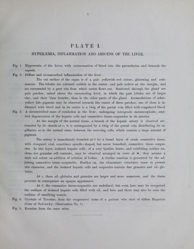 P L A T E I. HYPEREMIA, INFLAMMATION AND ABSCESS OF THE LIVER. Fig. 1. Hypenemia of the Liver, with extravasation of blood into the parenchyma and beneath the capsule. Fig. 2. Diffuse and circumscribed inflammation of the liver. The cut surface of the organ is of a pale yellowish-red colour, glistening and oede- matous. The lobules are coloured reddish in the centre, and pale yellow at the margin, and are surrounded by a grey rim from which serum flows out. Scattered through the gland are pale patches, raised above the surrounding level, in which the pale lobules are of larger size, and their Tims broader, than in the other parts of the gland. Accumulations of ochre- yellow bile-pigment may be observed towards the centre of these patches; one of them is in- filtrated with blood and in its centre is a twig of the portal vein filled with coagulated blood. Fig. 3. A circumscribed mass of exudation in the liver, undergoing retrograde metamorphosis; amy- loid degeneration of the hepatic cells and connective tissue-corpuscles in its interior. At the margin of the normal tissue, a branch of the hepatic artery is observed sur- rounded by its sheath at a; it is accompanied by a twig of the portal vein distributing its ca- pillaries, as in the normal state, between the secreting cells, which contain a large amount of pigment. The artery is immediately bounded at b bv a broad layer of crude connective tissue, with elongated oval, sometimes spindle-shaped, but never branched, connective tissue-corpus- cles. In this layer, isolated hepatic cells, of a very hyaline lustre, and exhibiting neither nu- cleus. nor granular cell contents, may be observed arranged in rows at * ; they assume a dark red colour on addition of solution of Iodine. A similar reaction is presented by the ad- joining connective tissue - corpuscles. Further on, the elementary structures cease to present this character, and the isolated hepatic cells and corpuscles contain fine granules and oil-glo- bules. At c, those oil - globules and granules are larger and more numerous, and the tissue presents in consequence an opaque appearance. At d, the connective tissue-corpuscles are undefined; but even here may be recognised the outlines of isolated hepatic cells filled with oil, and here and there may also be seen the outlines of ramifying vessels. Fig. 4. Crystals of Tyrosine, from the evaporated urine of a patient who died of difhise Hepatitis (Case of Selinsky, Observation Nr. 1). Fig. 5. Kreatine from the same urine.