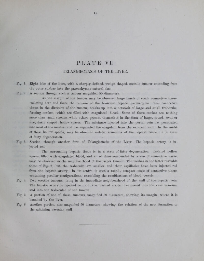PLATE VI. TELANGIECTASIS OF THE LIVER. Fig. 1. Right lobe of the liver, with a sharply-defined, wedge-shaped, erectile tumour extending from the outer surface into the parenchyma; natural size. Fig. 2. A section through such a tumour magnified 50 diameters. At the margin of the tumour may be observed large bands of crude connective tissue, enclosing here and there the remains of the brownish hepatic parenchyma. This connective tissue, in the direction of the tumour, breaks up into a network of large and small trabeculae, forming meshes, which are filled with coagulated blood. Some of these meshes are nothing more than small streaks, while others present themselves in the form of large, round, oval or irregularly shaped, hollow spaces. The substance injected into the portal vein has penetrated into most of the meshes, and has separated the coagulum from the external wall. In the midst of these hollow spaces, may be observed isolated remnants of the hepatic tissue, in a state of fatty degeneration. Fig. 3. Section through another form of Telangiectasis of the Liver. The hepatic artery is in- jected red. The surrounding hepatic tissue is in a state of fatty degeneration. Isolated hollow spaces, filled with coagulated blood, and all of them surrounded by a rim of connective tissue, may be observed in the neighbourhood of the larger tumour. The meshes in the latter resemble those of Fig. 2; but the trabeculae are smaller and their capillaries have been injected red from the hepatic artery. In its centre is seen a round, compact mass of connective tissue, containing peculiar configurations, resembling the ramifications of blood-vessels. Fig. 4. Two erectile tumours, lying in the immediate neighbourhood of the wall of the hepatic vein. The hepatic artery is injected red, and the injected matter has passed into the vasa vasorum, and into the trabeculae of the tumour. Fig. 5. A portion of one of these tumours, magnified 50 diameters, showing its margin, where it is bounded by the liver. Fig. 6. Another portion, also magnified 50 diameters, showing the relation of the new formation to the adjoining vascular wall.