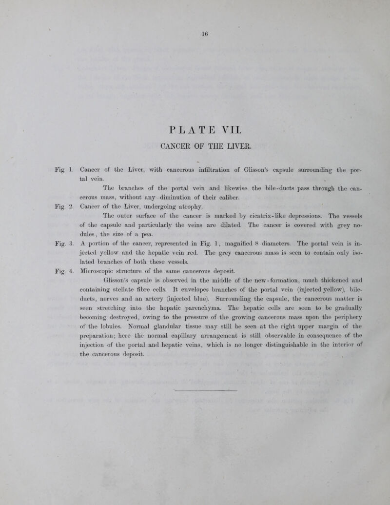 PLATE VII. CANCER OF THE LIVER. Fig. 1. Cancer of the Liver, with cancerous infiltration of Glisson’s capsule surrounding the por- tal vein. The branches of the portal vein and likewise the bile-ducts pass through the can- cerous mass, without any diminution of their caliber. Fig. 2. Cancer of the Liver, undergoing atrophy. The outer surface of the cancer is marked by cicatrix-like depressions. The vessels of the capsule and particularly the veins are dilated. The cancer is covered with grey no- dules , the size of a pea. Fig. 3. A portion of the cancer, represented in Fig. 1, magnified 8 diameters. The portal vein is in- jected yellow and the hepatic vein red. The grey cancerous mass is seen to contain only iso- lated branches of both these vessels. Fig. 4. Microscopic structure of the same cancerous deposit. Glisson’s capsule is observed in the middle of the new-formation, much thickened and containing stellate fibre cells. It envelopes branches of the portal vein (injected yellow), bile- ducts, nerves and an artery (injected blue). Surrounding the capsule, the cancerous matter is seen stretching into the hepatic parenchyma. The hepatic cells are seen to be gradually becoming destroyed, owing to the pressure of the growing cancerous mass upon the periphery of the lobules. Normal glandular tissue may still be seen at tbe right upper margin of the preparation; here the normal capillary arrangement is still observable in consequence of the injection of the portal and hepatic veins, which is no longer distinguishable in the interior of the cancerous deposit.